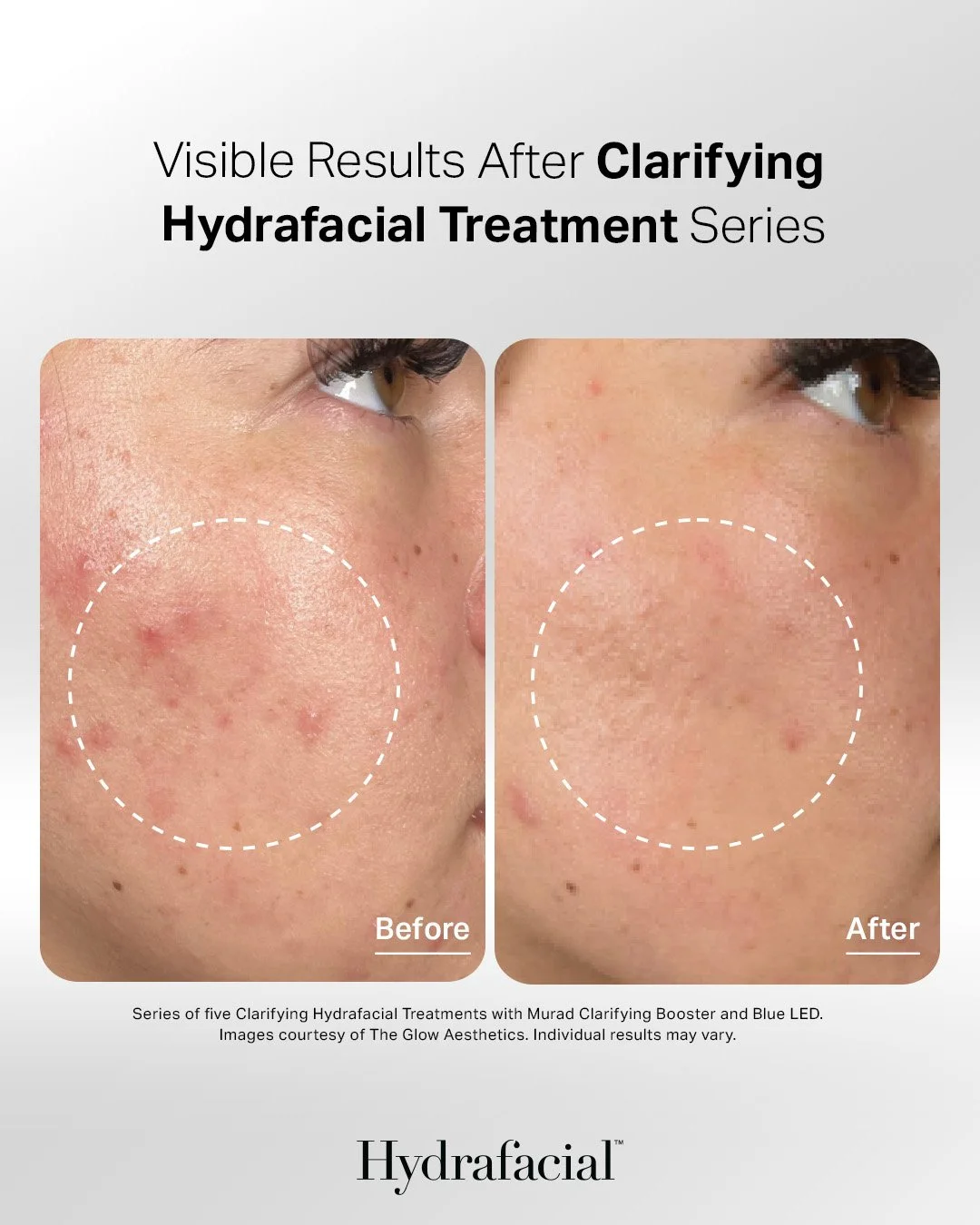 Side-by-side comparison of a person's cheek before and after Clarifying Hydrafacial Treatment, showing clearer skin post-treatment.