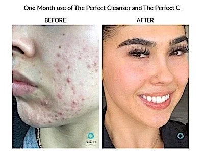 Comparison of a person's face showing acne before and after one month of using The Perfect Cleanser and The Perfect C.
