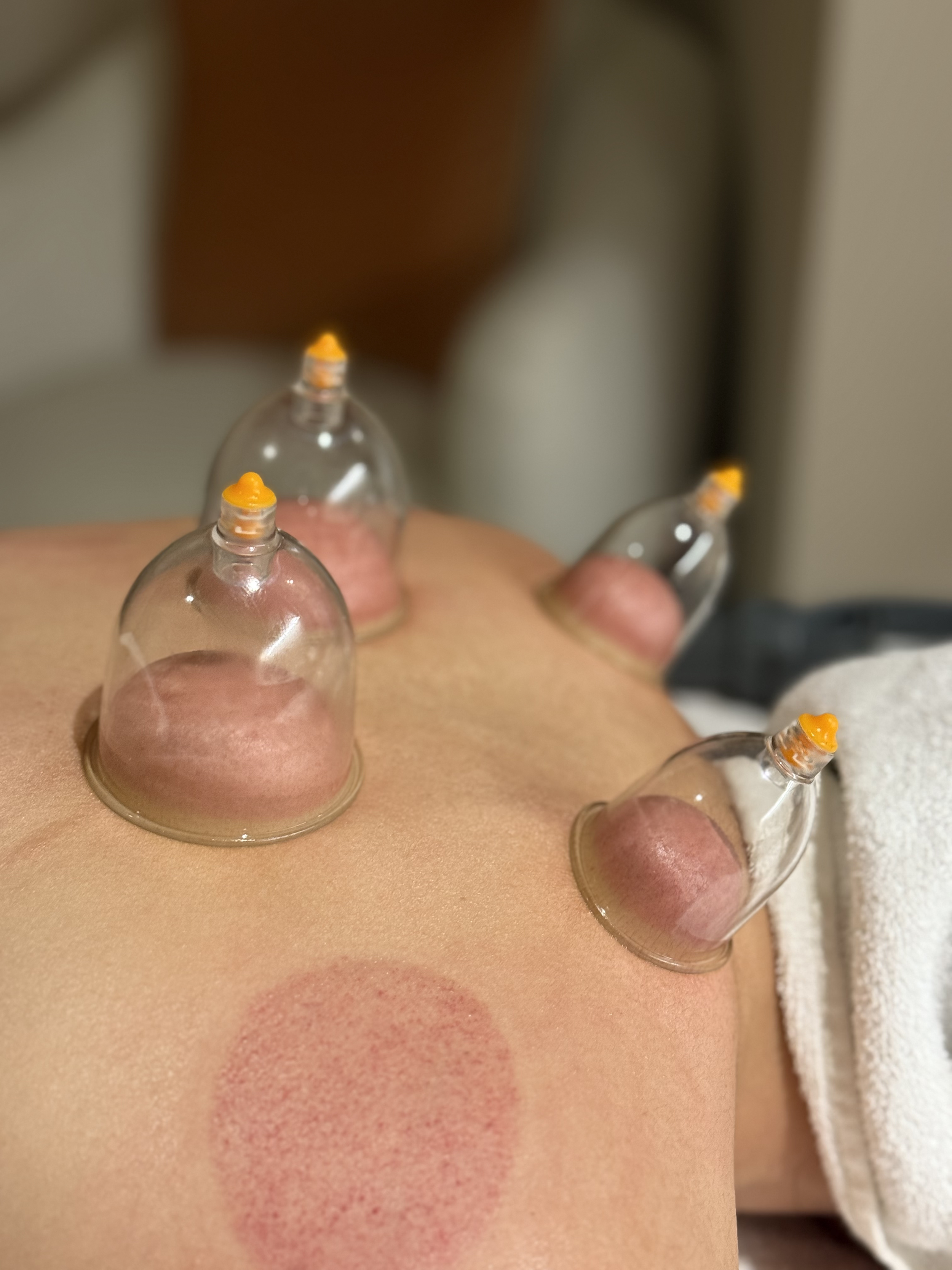 Cupping Therapy: A Restorative Ritual at Kai