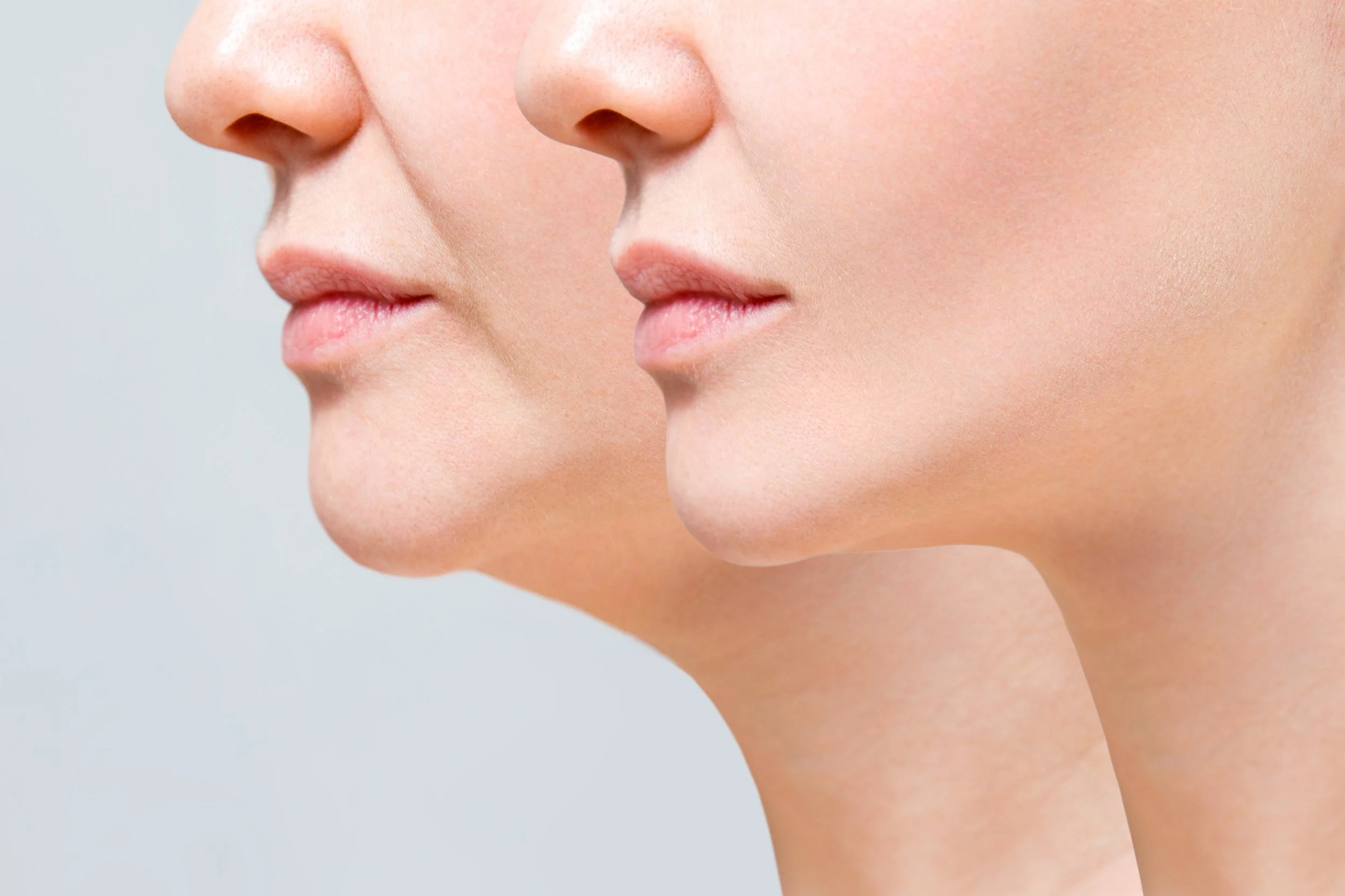 Side-by-side comparison of a woman's profile before and after a cosmetic procedure, showing smoother skin and a more defined jawline in the after image.