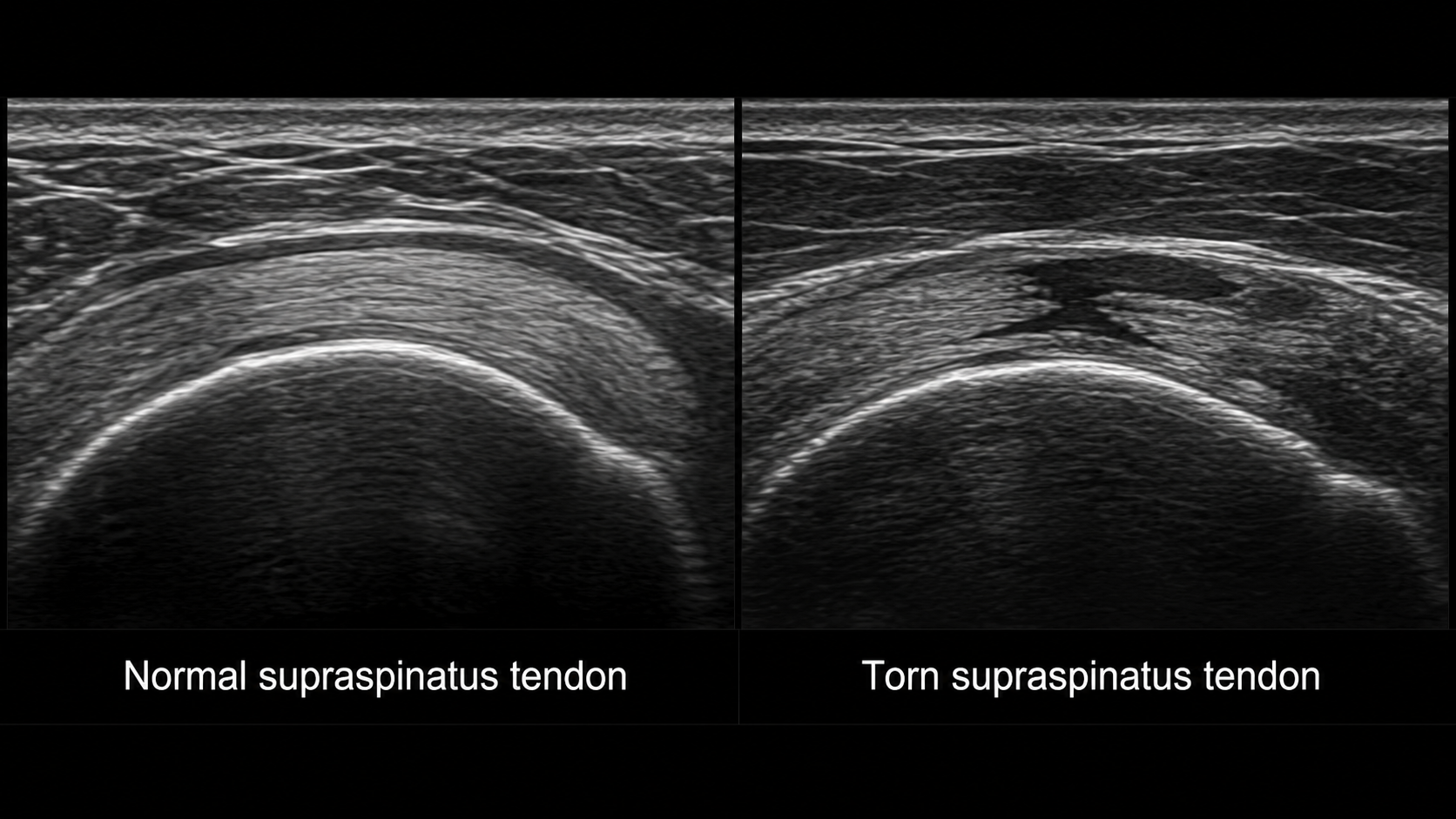 Ultrasound image comparing a normal and torn supraspinatus tendon, with labels indicating 'Normal supraspinatus tendon' on the left and 'Torn supraspinatus tendon' on the right.