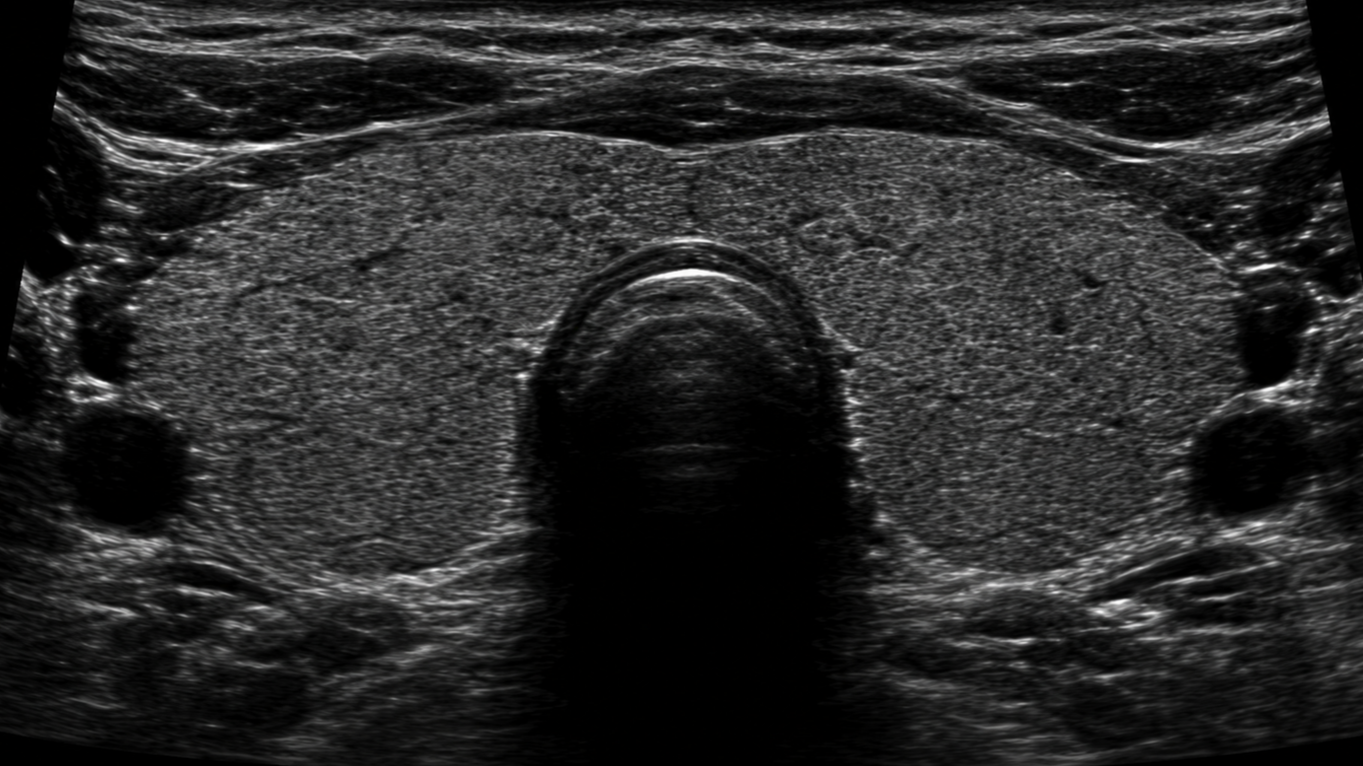 Ultrasound image of male prostate with bladder and surrounding tissues visible.