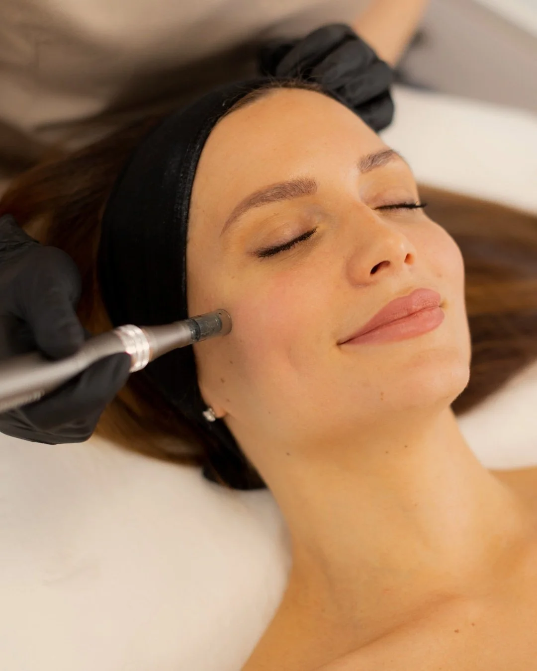 Microneedling with PRF treatment in Portland Oregon