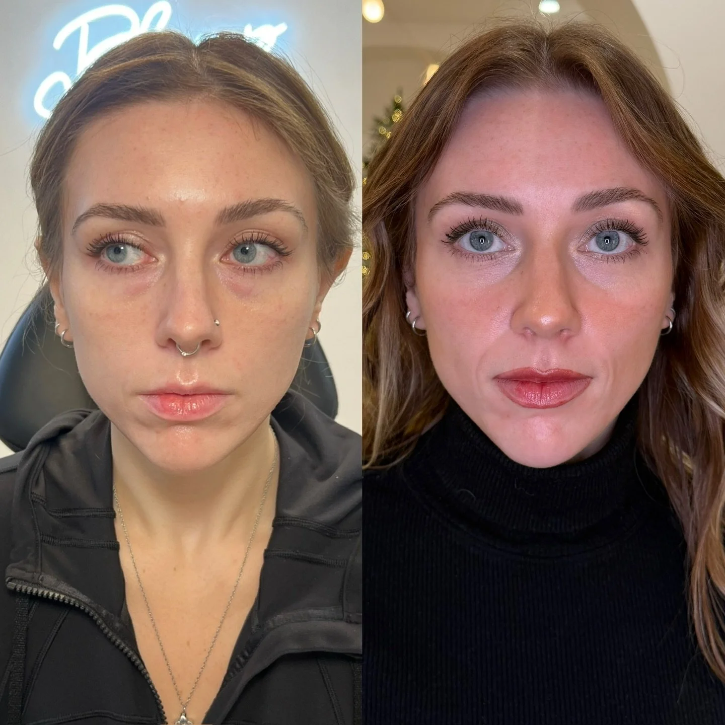Collagen Stimulation with Radiesse 

Product used: Blended and Standard Radiesse 

Treatment areas: Temples, lateral and mid cheek support, and panfacial fanning of the product in the intradermal space for tightening the dermis. 

Results are taken b