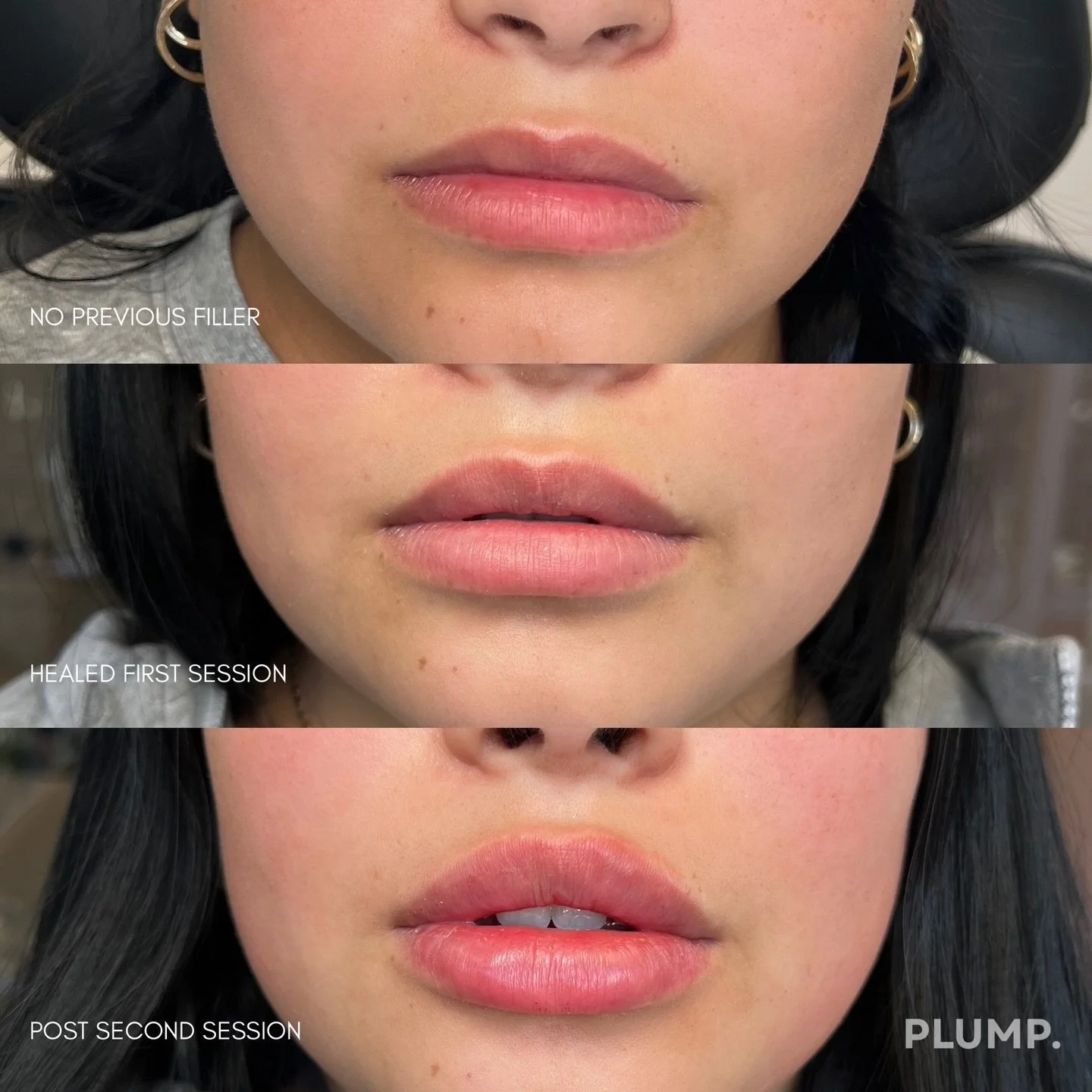 The process of achieving your ideal lip size may not happen overnight. 

We have found that the most appropriate way to safely build your lips goes as follows: 

1. Consult with your provider: Ensure that your goals align with with them. Provide insp