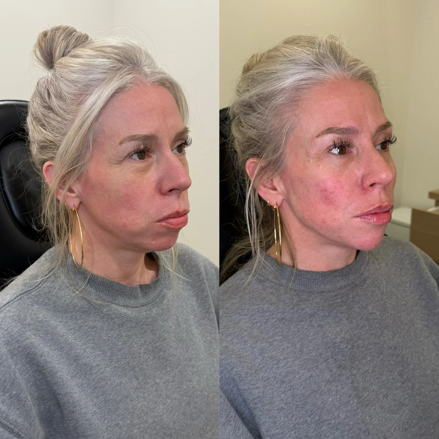 Facial Balancing 

Treatment plan outlined below ⤵️

&bull;Radiesse utilized both its in standard volumization form (temples, cheeks) and biostimulatory form (preauricular, mental crease, marionettes)
&bull;Filler in the chin for length and projectio