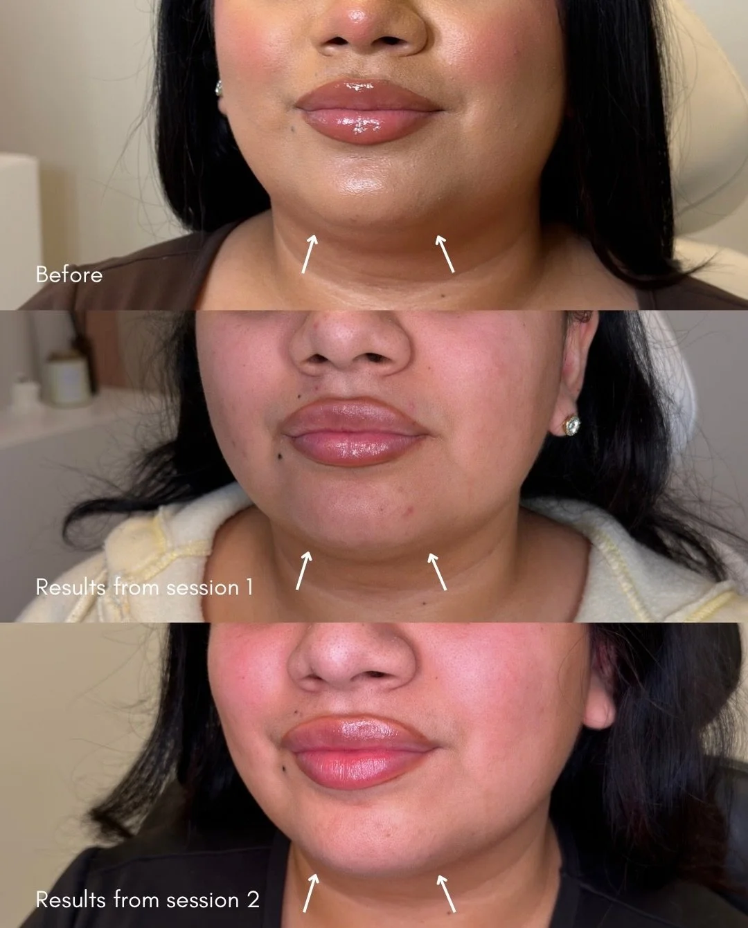 Submental contouring with PCDC.

This non-surgical injectable works by targeting and breaking down fat cells in the submental (&ldquo;double chin&rdquo;) area&mdash;once treated, those fat cells do not return.

Because fat reduction is gradual, multi