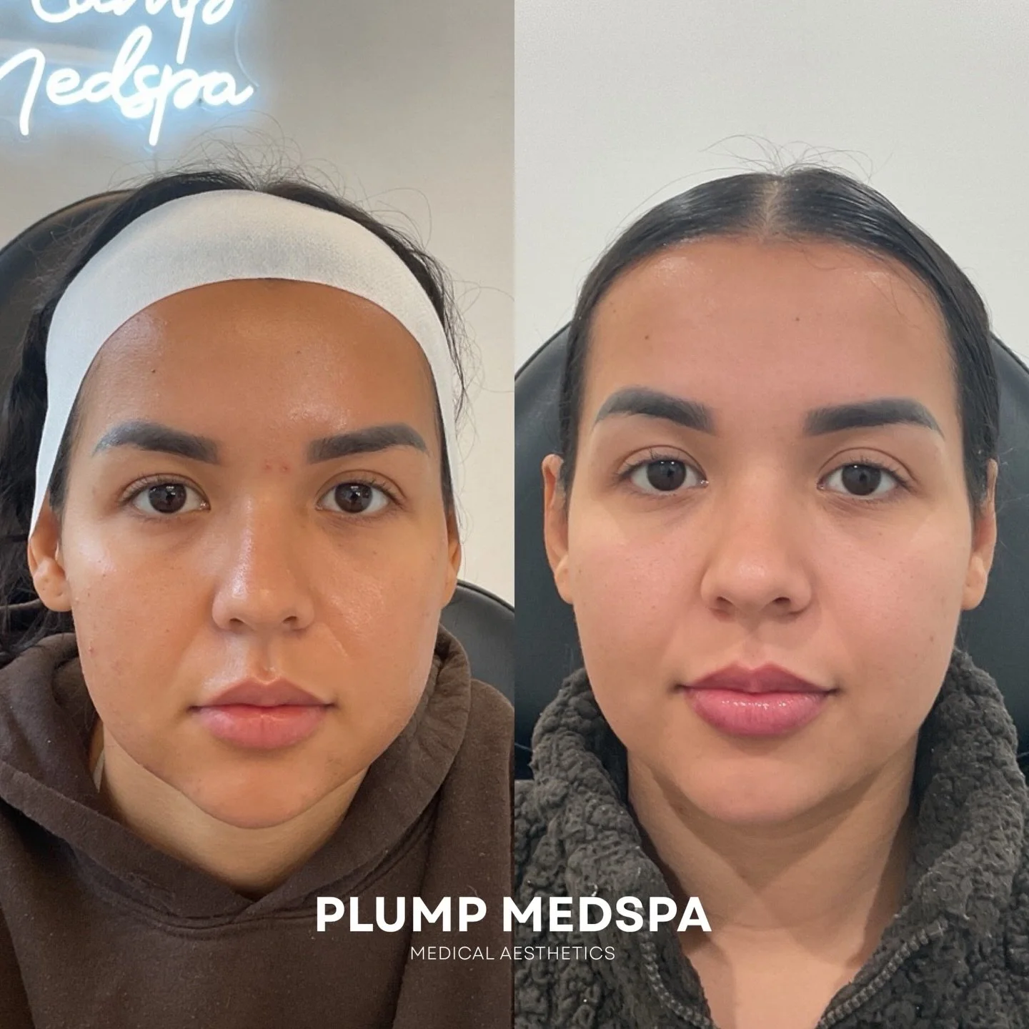 Skin quality, barrier, and brightness by Salmon DNA Microneedling (PDRN). 

PDRN (Polydeoxyribonucleotide) is best indicated for those with sensitive skin, acne prone skin, dehydrated skin, or post inflammatory pigmentation. 

Microneedling with PDRN