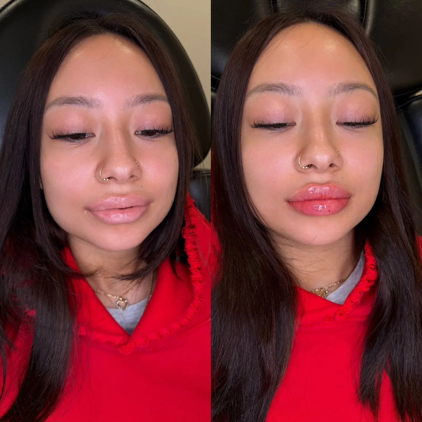 Our Plump Lip Technique by our founder @ninapherigo 

Location: Plump Medspa 
Service: Lip Filler 

&bull; Immediate swelling ~30%, settles over ~2 weeks
&bull; Photos shared with consent
&bull; Numbing provided for comfort
&bull; Multiple sessions m