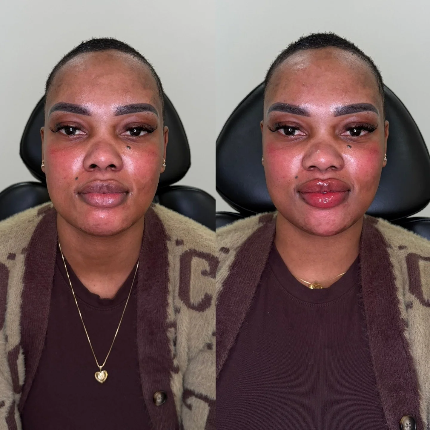 It&rsquo;s all in the lower face. 

When we assess the face, we assess it in thirds. This beautiful patient has perfectly balanced features in the two upper thirds of her face. As we travel to the lower third of the face, it was noted that subtle vol