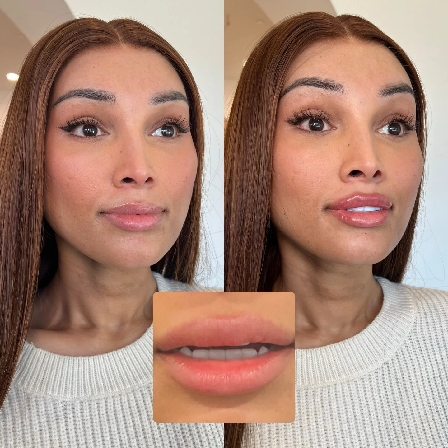 There&rsquo;s nothing better than actually being able to see your teeth with lip filler. 

That was one of the priorities that my patient had when it came to her dissolve and refill. Her previous filler had collected into the central portion or her l