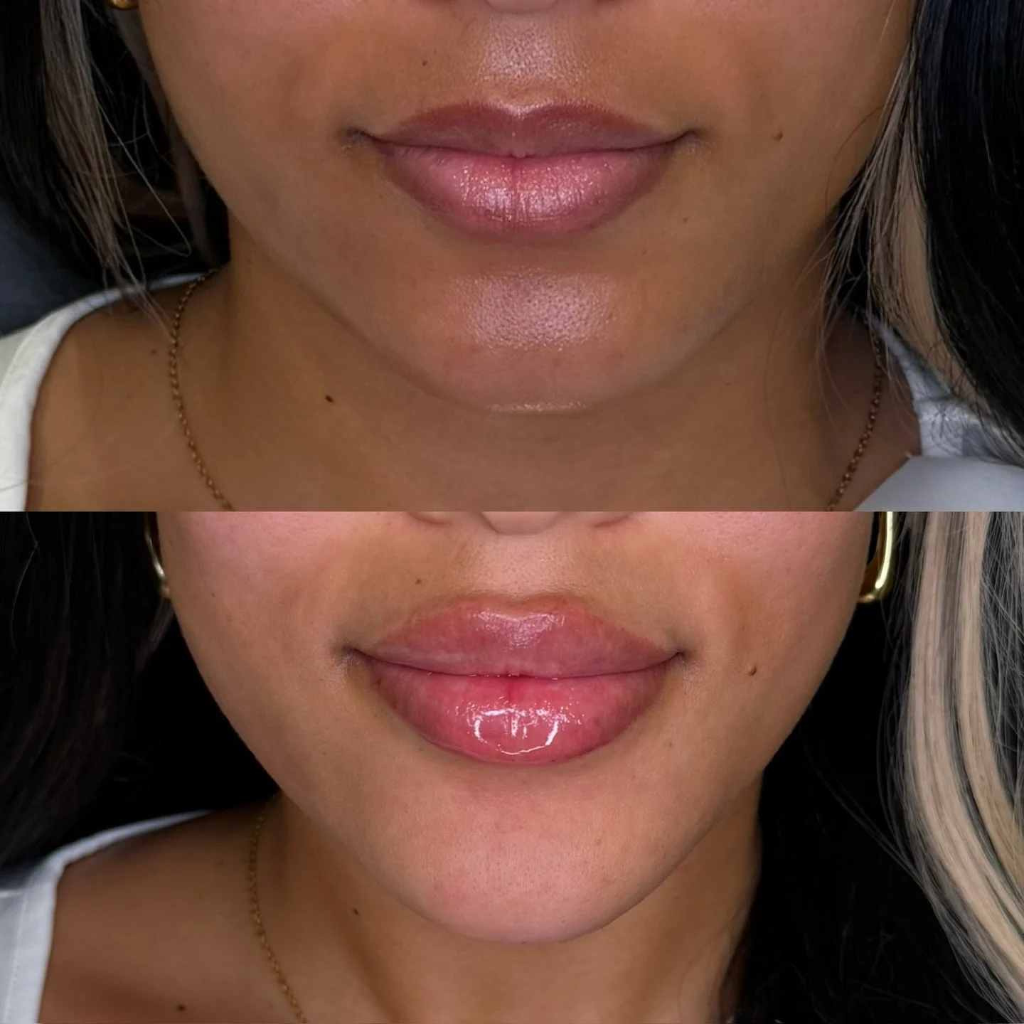 Lip Enhancement + Full Facial Balancing

Facial Balancing has been previously highlighted in our content, but these lips needed their own moment!

Details of this Lip Augmentation:

Cupids bow peaks are brought closer together and are more lifted to 