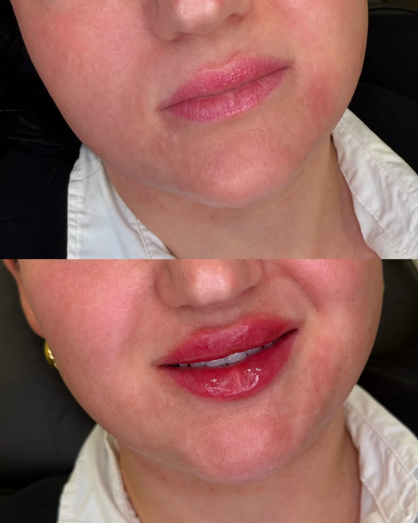 Dissolving and refilling can be tricky.

It is a delicate process that requires close attention to the patient&rsquo;s anatomical lip shape, areas of volume versus areas with deficits, and many other factors.

The client&rsquo;s requests for her serv