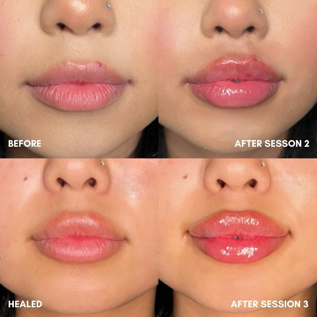 Patience is key when building your goal lips. Most clients will require 2-3 sessions in order to achieve their desired lip goals. 

This client had an existing foundation of filler prior to our first session together. In total, she has had a total of