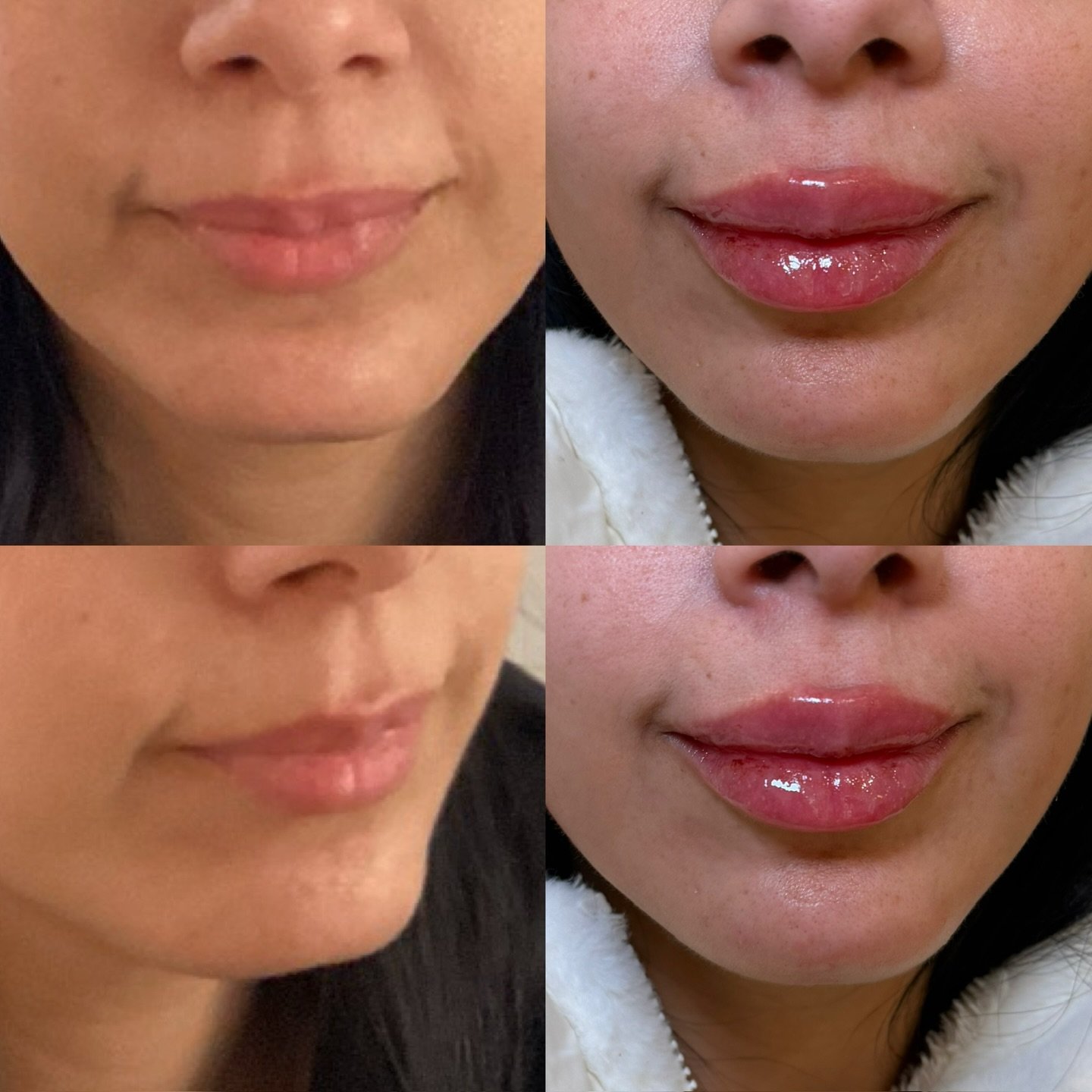 Decreased philtrum length: explained below ⤵️

The philtrum length is the area referred to as the distance or space between the Cupids bow and the base of the nose. 

The distance increases with age or may be present due to genetics. By decreasing th