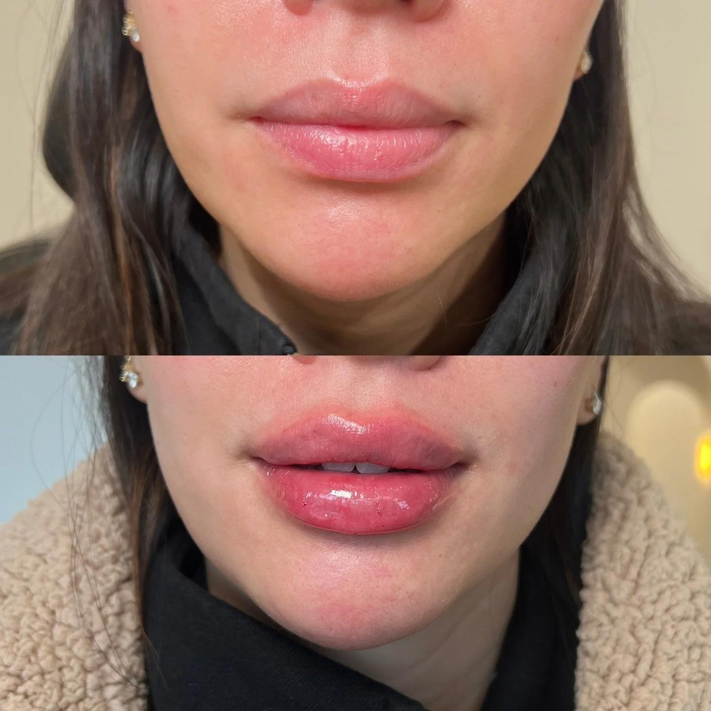 Perfectly defined, your way&mdash; with the Classic Lip at Plump Medspa

Location: Plump Medspa 
Service: Lip Filler 

&bull; Immediate swelling ~30%, settles over ~2 weeks
&bull; Photos shared with consent
&bull; Numbing provided for comfort
&bull; 