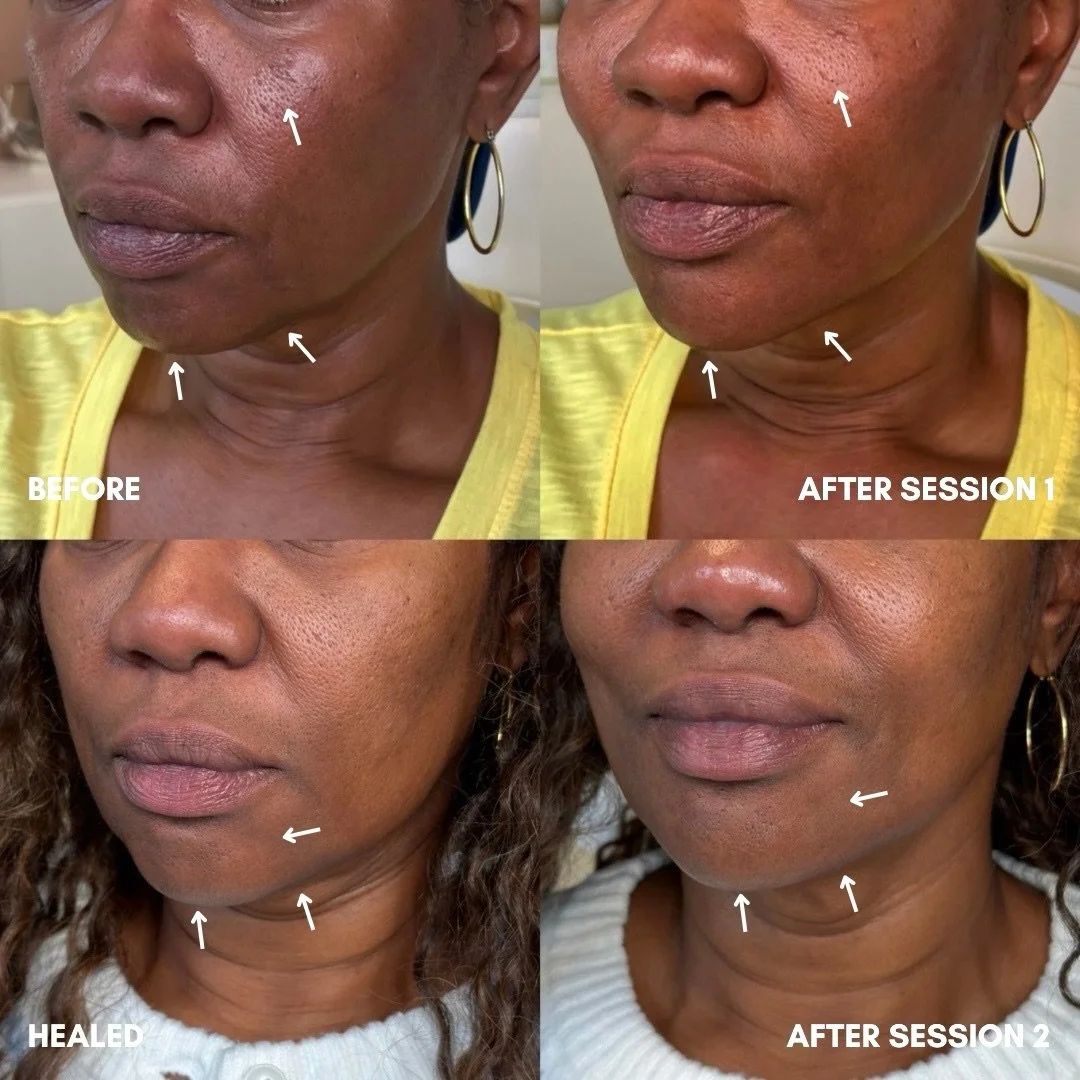 Facial Balancing: The Art of Harmonizing Your Features

True facial rejuvenation is a process of restoration and structural strengthening. To achieve a result that is both impactful and natural, a phased approach is often required. This patient&rsquo