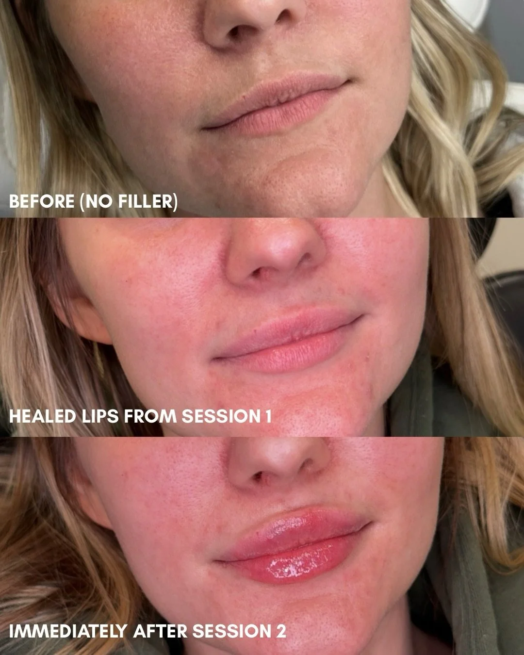 Transforming the lips from their natural anatomical state to your desired aesthetic goal is rarely achieved in a single appointment.

To maintain tissue integrity and ensure precise product placement, most patients will require 2-3 sessions over time