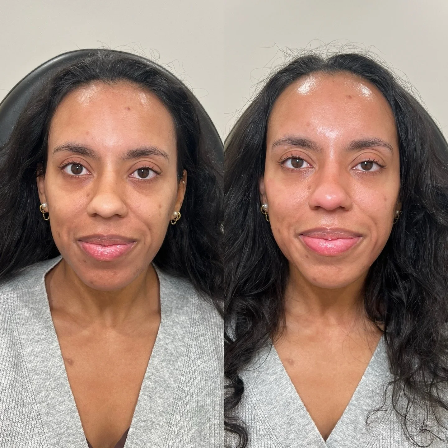 Unlocking her inner glow with the power of Biostimulators 

A term many of you have likely heard, either from us or from online presence. We have seen a shift in the Aesthetic realm from doing the MOST, to doing enough. Enough to have a greater chang