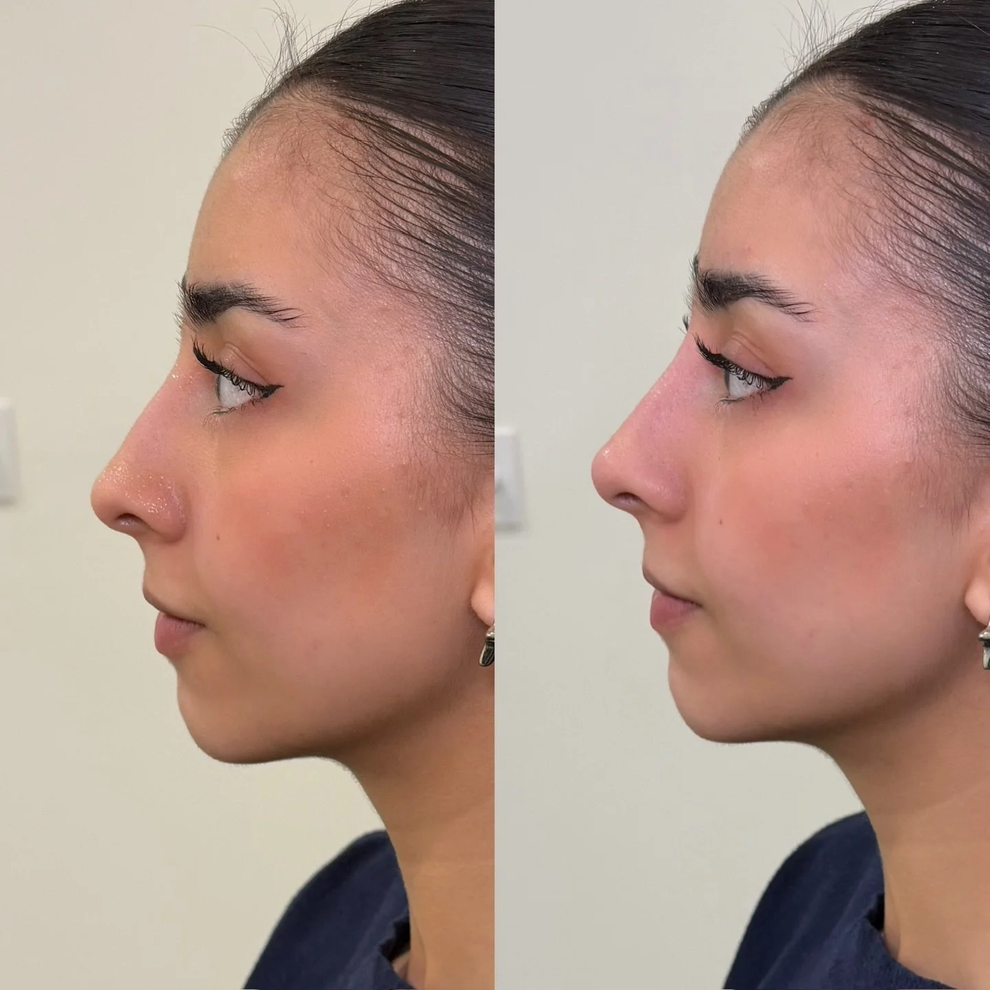 Liquid Rhinoplasty 

She came in wanting subtle enhancement without surgery. This was her third treatment in this area, it has been two years since her last treatment. The goal was to smooth the profile, soften a slight dorsal hump, and create a more