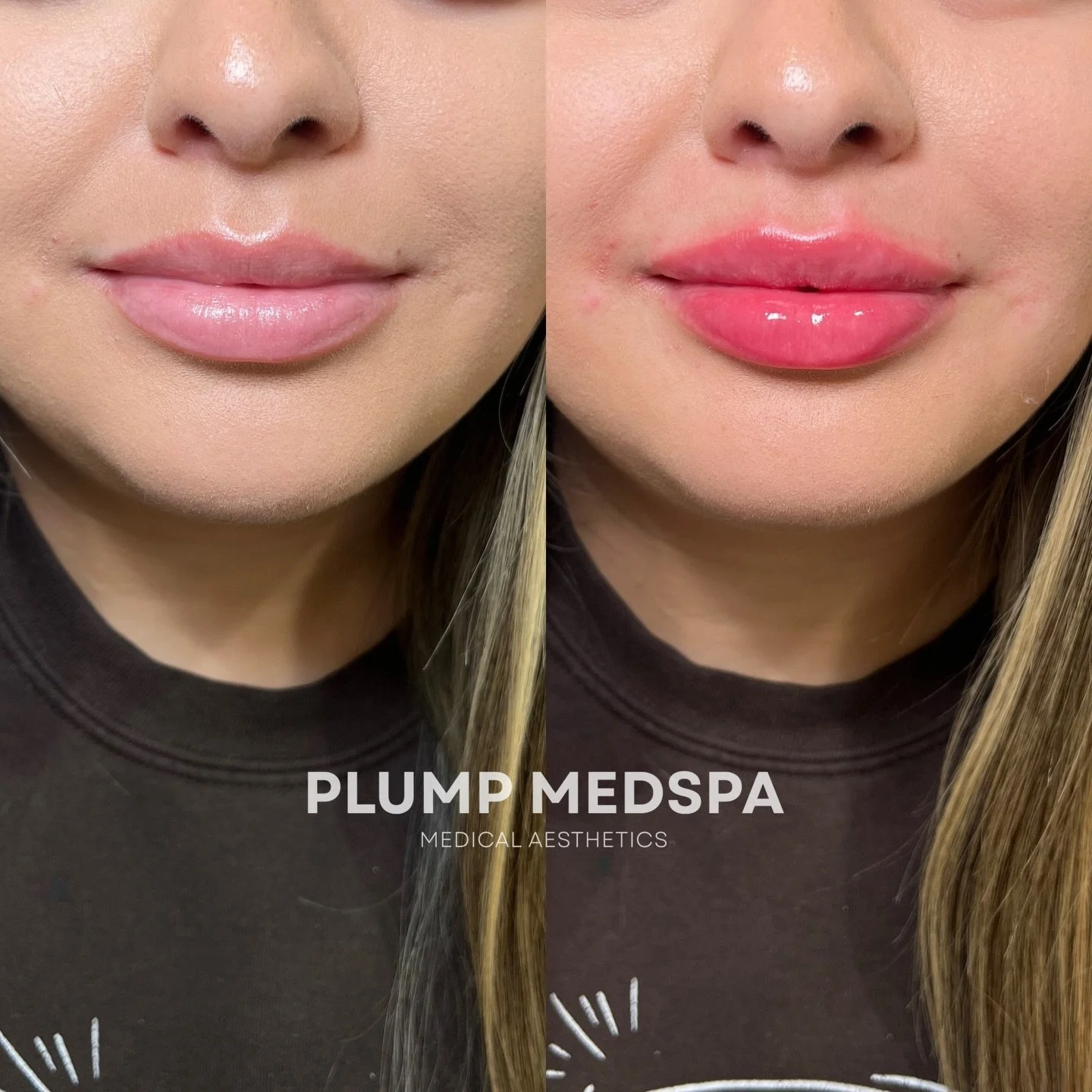 Lip Filler, the ultimate Valentine&rsquo;s Day Gift 

Ft. Classic Lips by @plumpedbyemma 

Location: Plump Medspa 
Service: Lip Filler 

&bull; Immediate swelling ~30%, settles over ~2 weeks
&bull; Photos shared with consent
&bull; Numbing provided f
