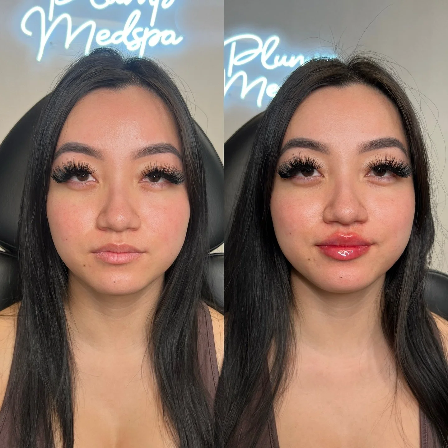 Feminine definition with a sophisticated, flat profile. This is the Plump Russian Lip technique.

Location: Plump Medspa
Service: Russian Lip Filler

&bull; Immediate swelling ~30%, settles over ~2 weeks
&bull; Photos shared with consent
&bull; Numbi