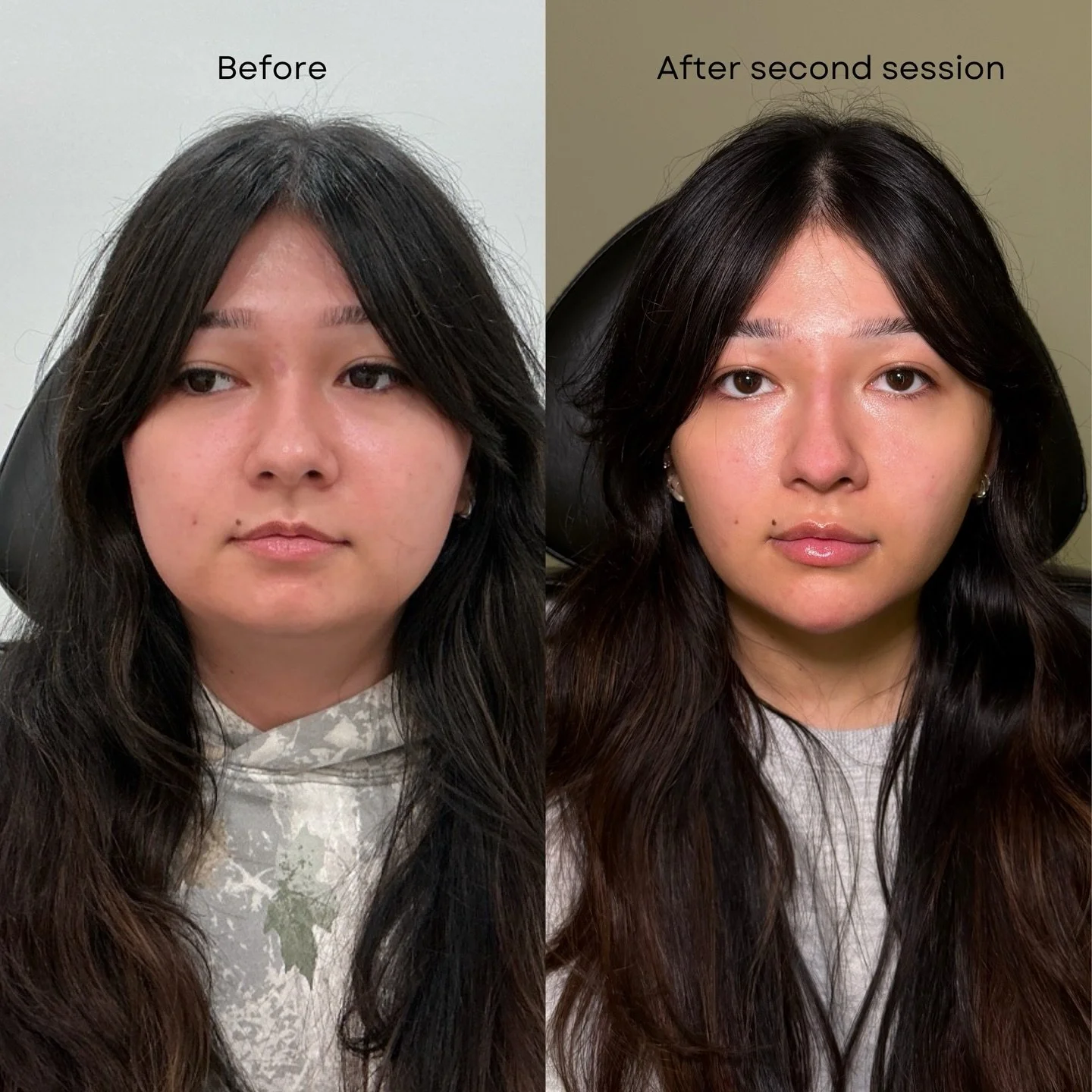 Chin filler + liquid rhinoplasty for profile balance

This was her second treatment as part of a full facial balancing plan. After previously treating with Xeomin in her masseters to slim her jawline and strategic filler, we continued refining her pr