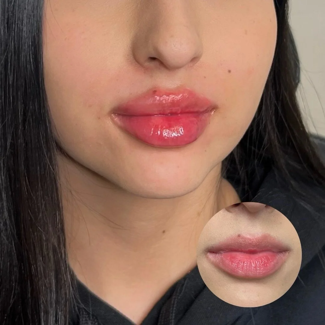 The Russian Lip Technique

For this transformation, our focus was all about architecture. The Russian Lip technique allows us to prioritize vertical lift over horizontal projection.

Here&rsquo;s how we achieved this look:

&bull; Sharper definition: