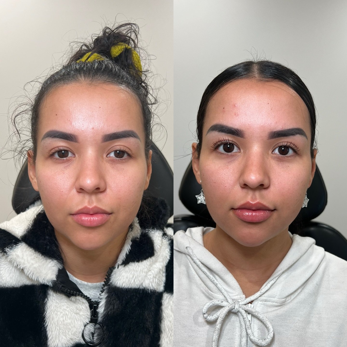 Healed: Facial Balancing + Microneedling with Salmon DNA +Toxin 

When treating the face we must consider all aspects: Volume &amp; Shadowing, The Skin, &amp; Musculature. 

We must tend to all three elements in order to yield the greatest result. 

