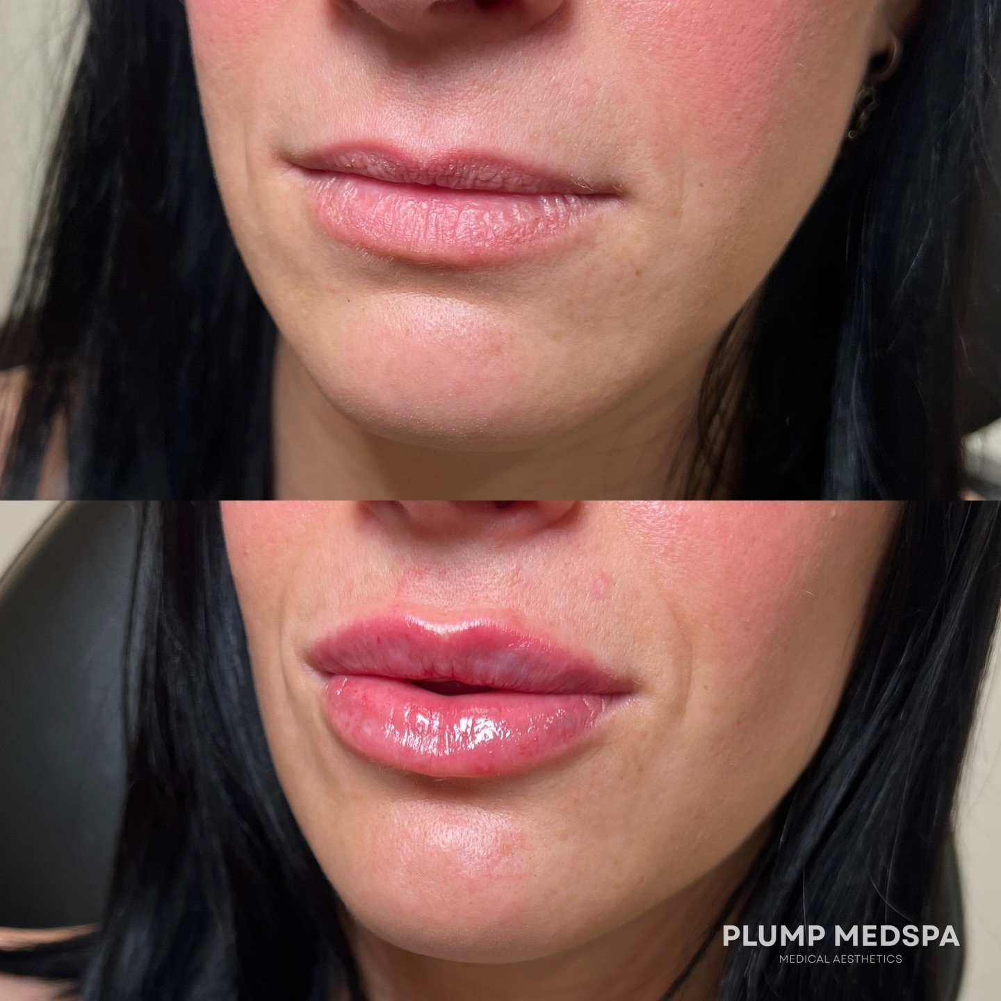 Lip Filler doesn&rsquo;t need to completely change your lips&mdash; but it can bring them back to LIFE. 

What I love most about these lips is how they compliment her face. They don&rsquo;t draw away from her natural beauty, instead they compliment t