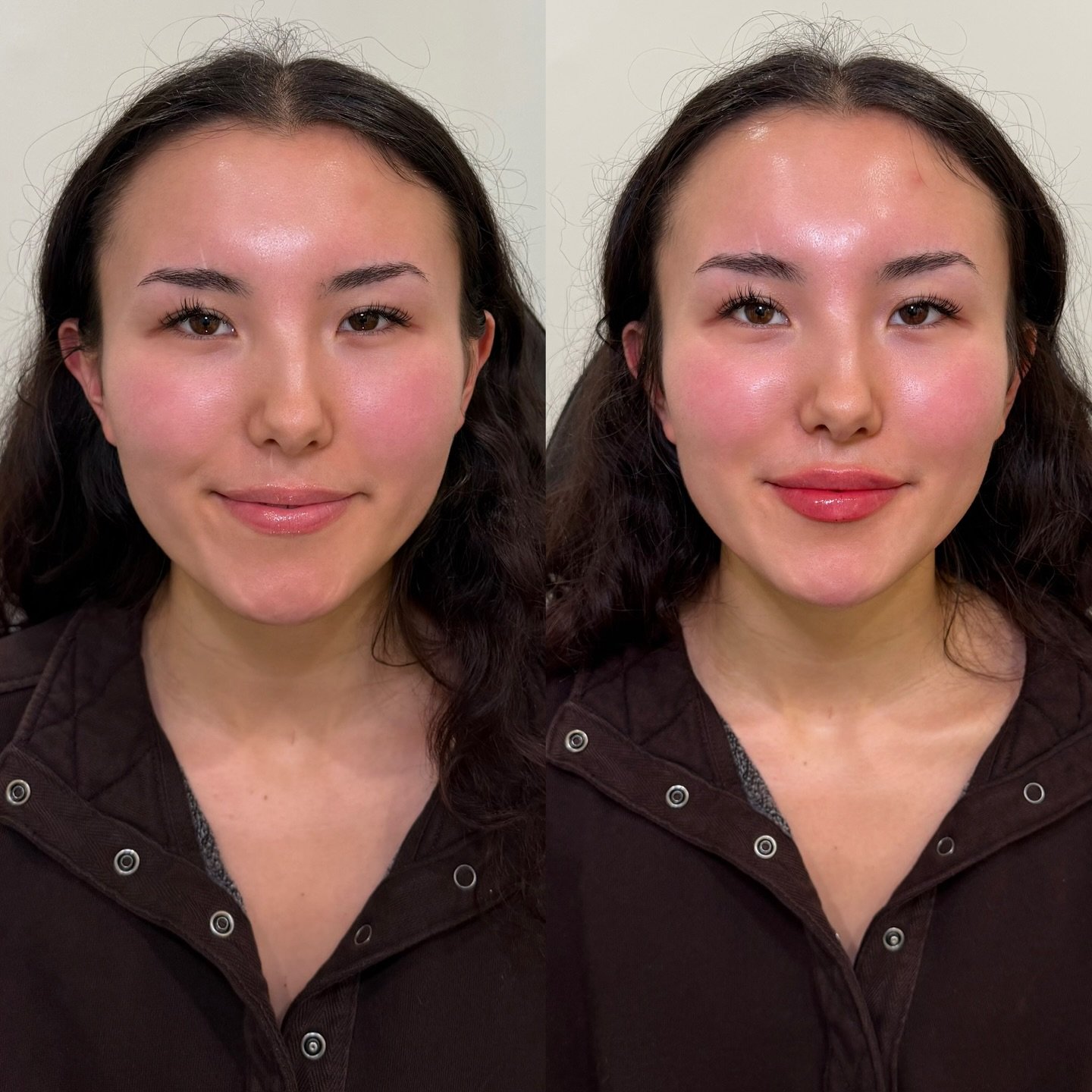 Chin + lip filler for first-time facial balancing

This was her very first filler appointment, and the goal was subtle, intentional enhancement. We treated the lips with one syringe of filler to maintain softness and movement, then added chin and chi