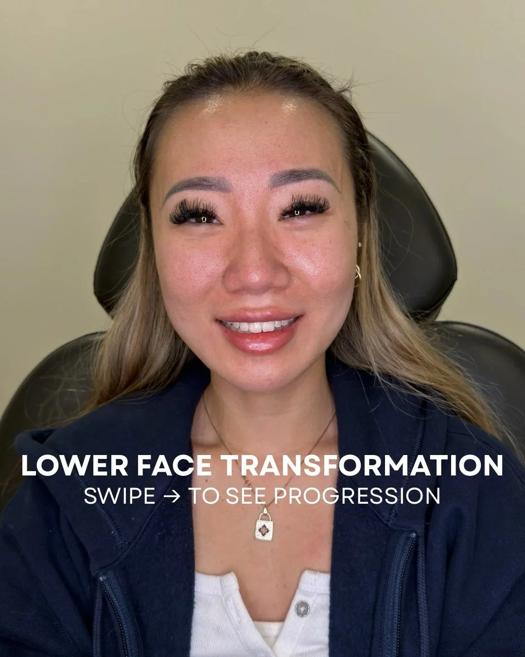 This patient&rsquo;s transformation has taken place slowly over time.

At our original appointment, the client&rsquo;s concerns were:
&bull; Creating a slim, tapered appearance to her lower face
&bull; Building and maintaining volume in her lips
&bul