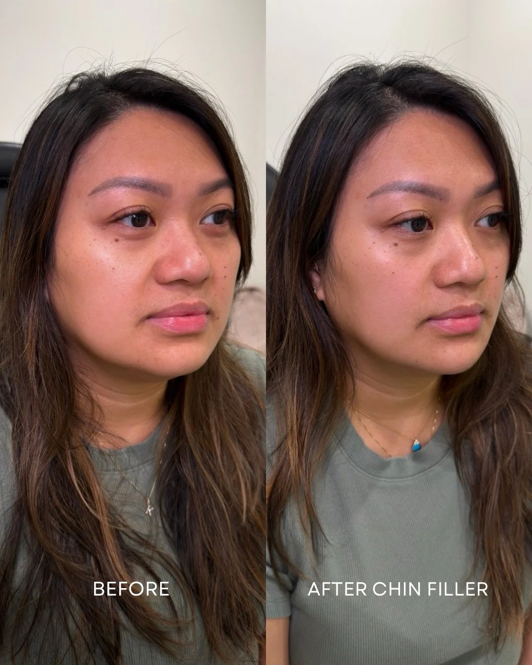 The natural descent of fat pads in the face occurs with age.

This downward shift of tissue over time contributes to the loss of definition in the lower face.

For this patient, we utilized HA filler to decrease the appearance of her chin shadows, re