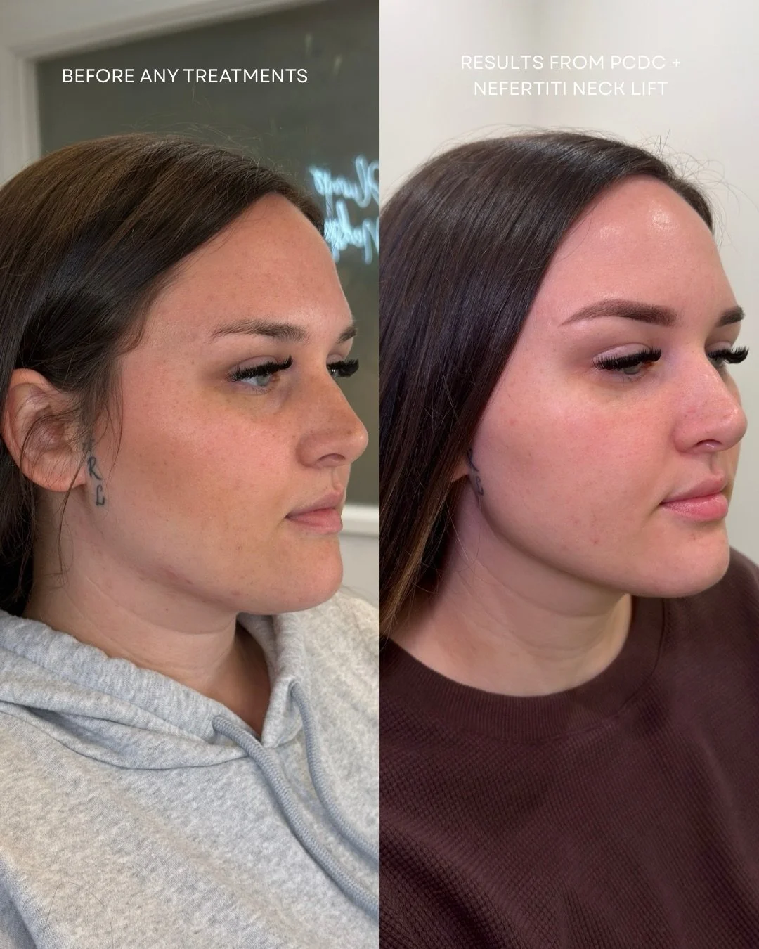 Defining and contouring the jawline doesn&rsquo;t always mean using filler.

My patient came to her first appointment and shared her goal of wanting to add more definition to her lower face/jawline.

We used a multimodal approach to help her reach th