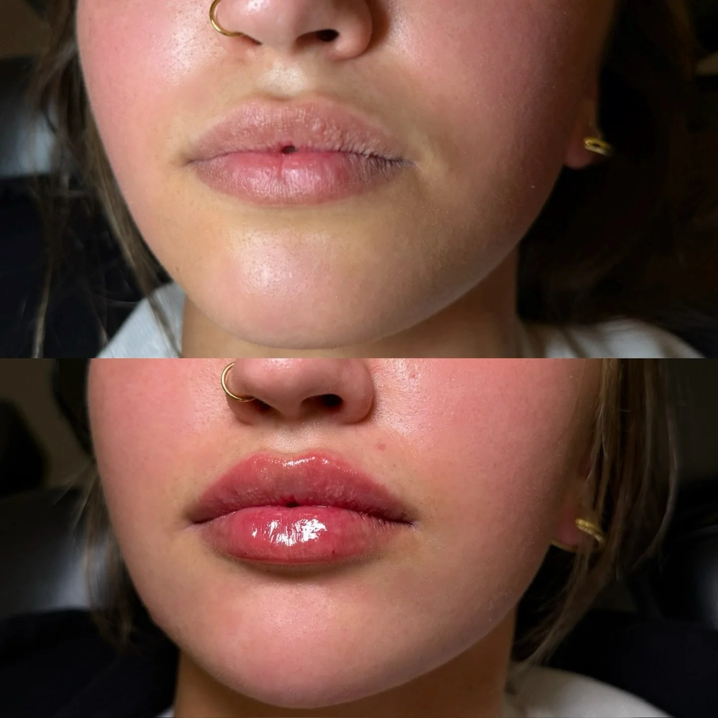 Lip filler + lower face balancing

This treatment focused on enhancing the lips while creating harmony throughout the lower face. We refined shape and volume in the lips, then strategically placed filler in the chin and surrounding areas to improve p