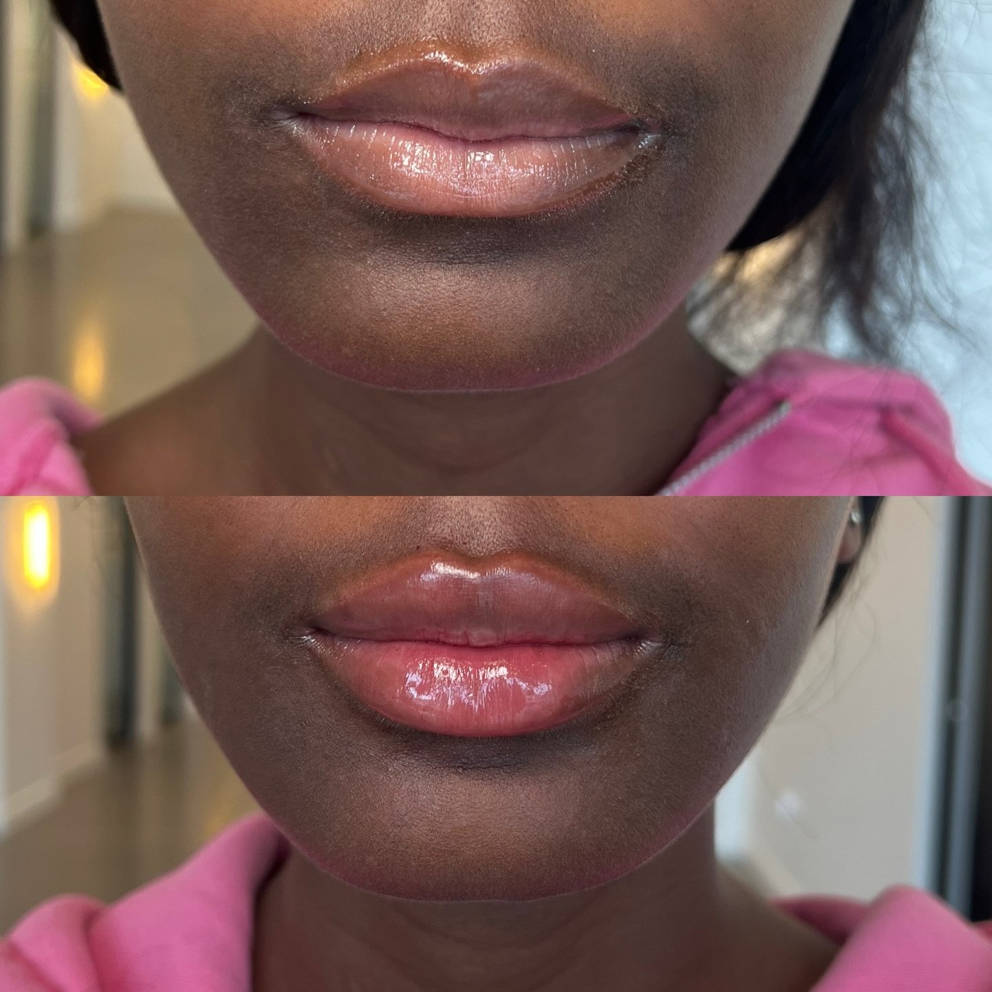The ideal lip. @plumpedbyemma 

Location: Plump Medspa 
Service: Lip Filler 

&bull; Immediate swelling ~30%, settles over ~2 weeks
&bull; Photos shared with consent
&bull; Numbing provided for comfort
&bull; Multiple sessions may be needed depending