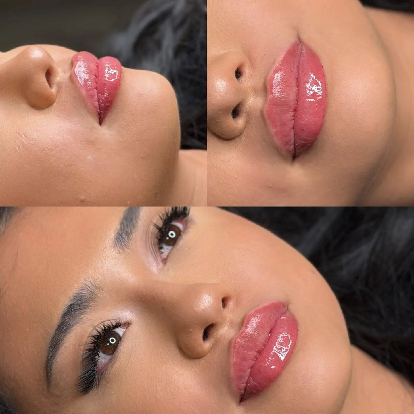 Lip filler before and after

This treatment focused on enhancing shape, balance, and soft volume while maintaining a natural look. Strategic placement allowed us to refine the borders, support the Cupid&rsquo;s bow, and create a smoother, more balanc