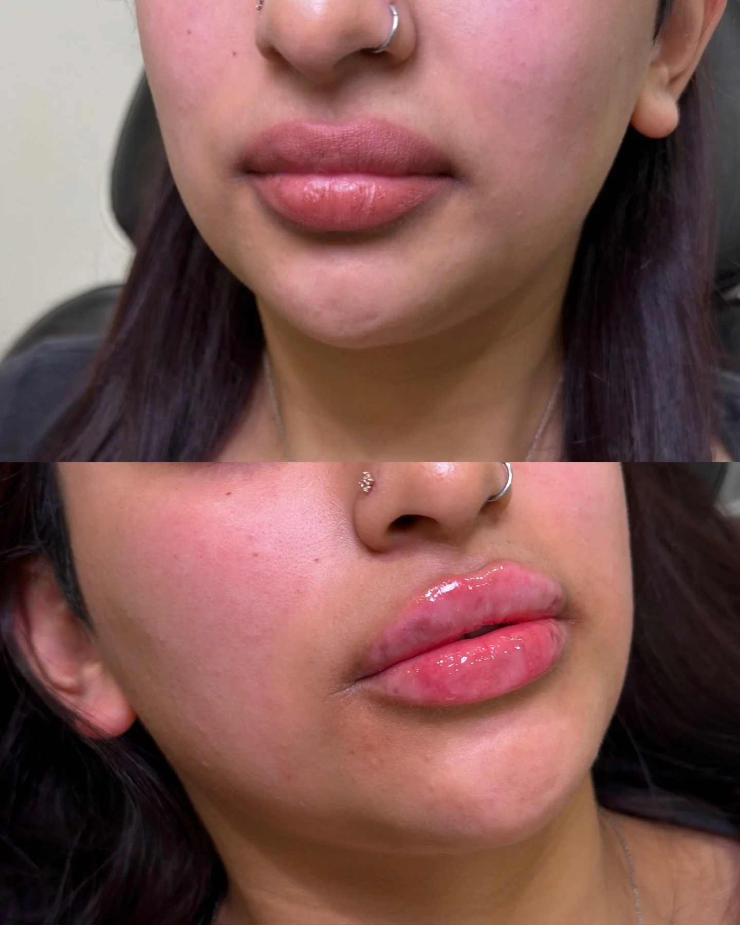 Lip filler session with a focus on redefining and maintaining.

This client already had an existing base of well-maintained lip filler from our practice. 

At this appointment, we simply made subtle adjustments to refresh and rehydrate what was alrea