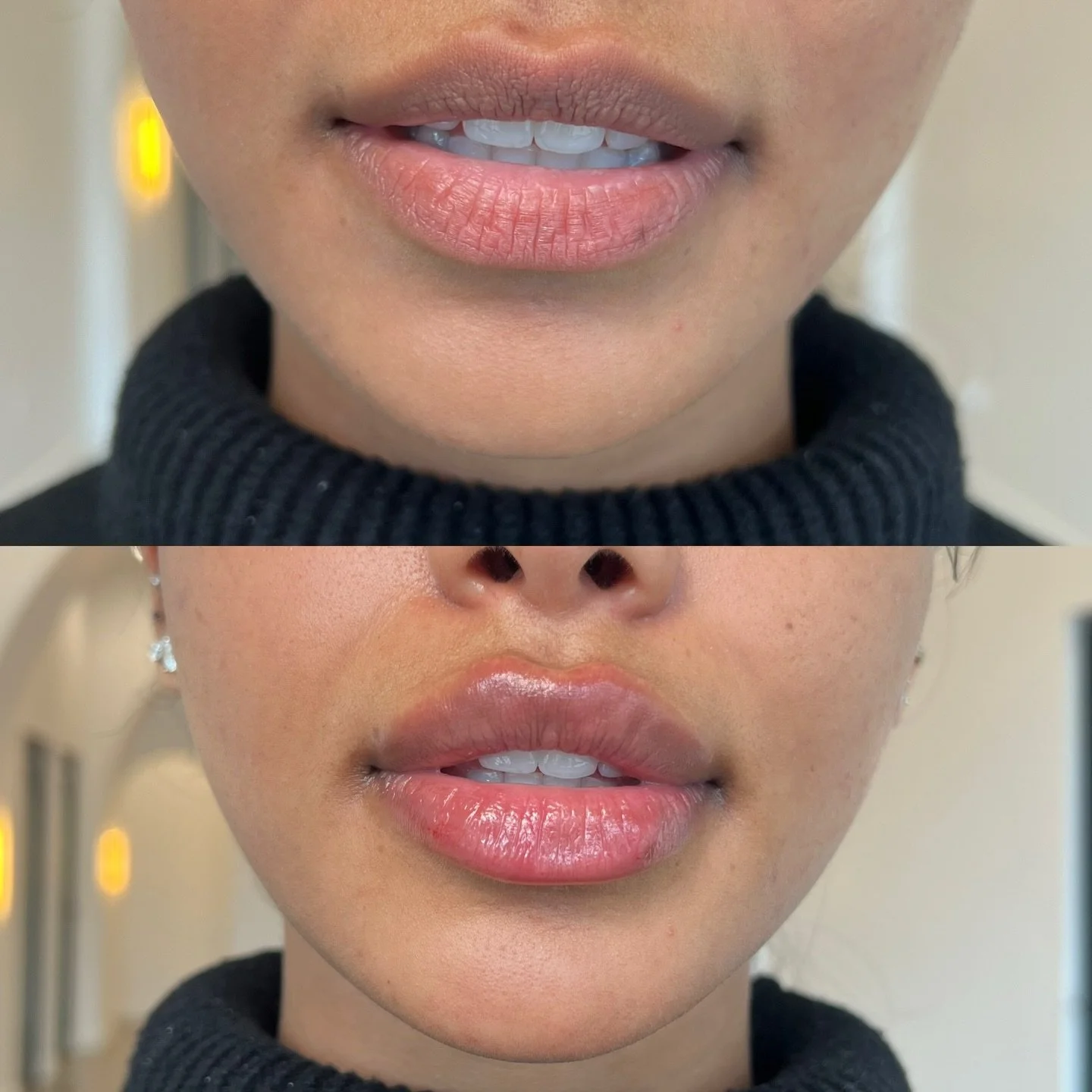 The fact that you can just tell this patient is gorgeous by only seeing her lower face is insane!

She came to see me all the way from Seattle. I feel so blessed to have people travel from different states to indulge in our expertise. It was importan