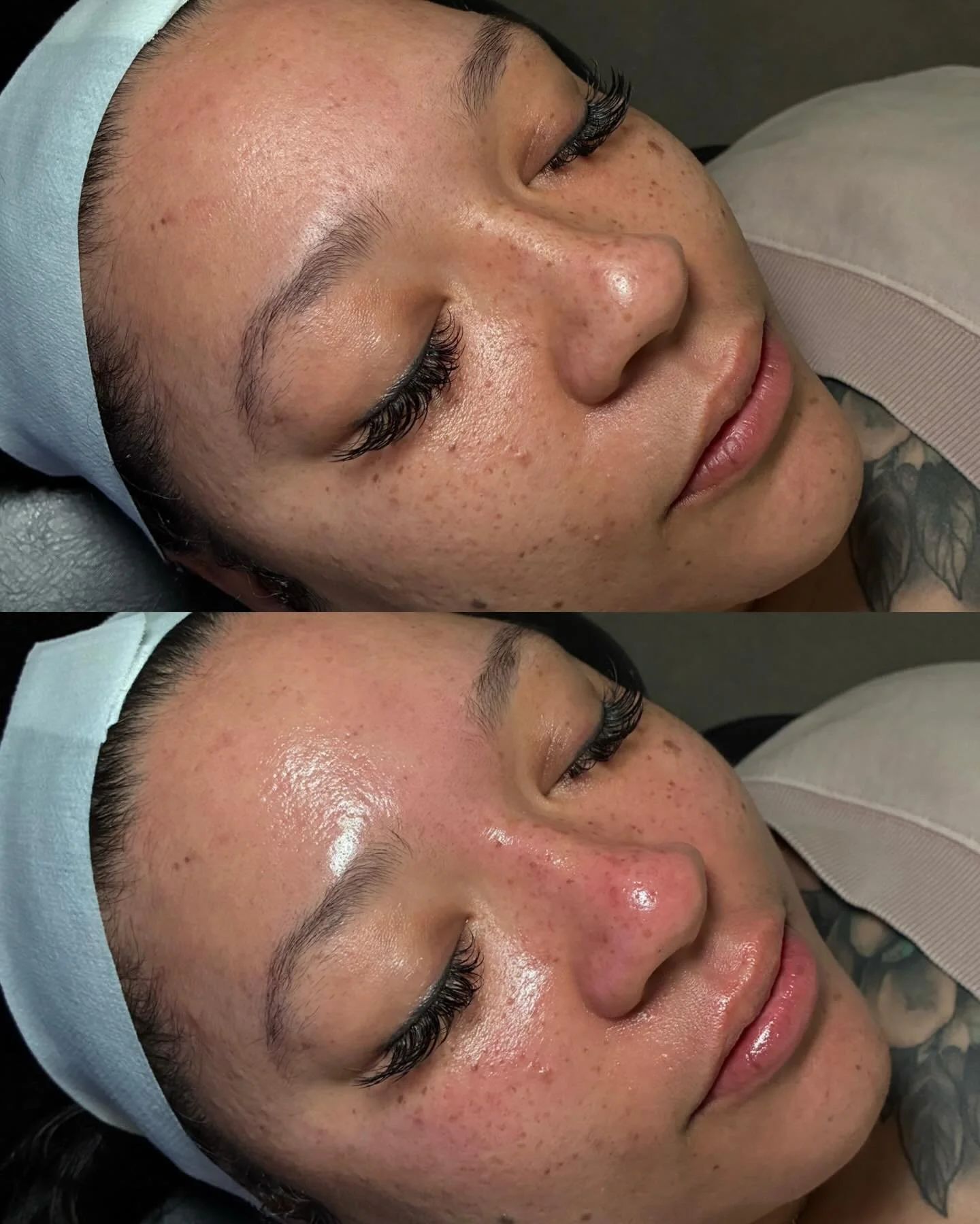 A Signature HydraFacial focusing on counteracting skin dullness and congestion.

This was this beautiful clients first HydraFacial and the glow speaks for itself. We included a milia extraction she had been wanting to get rid of for years! 

Location