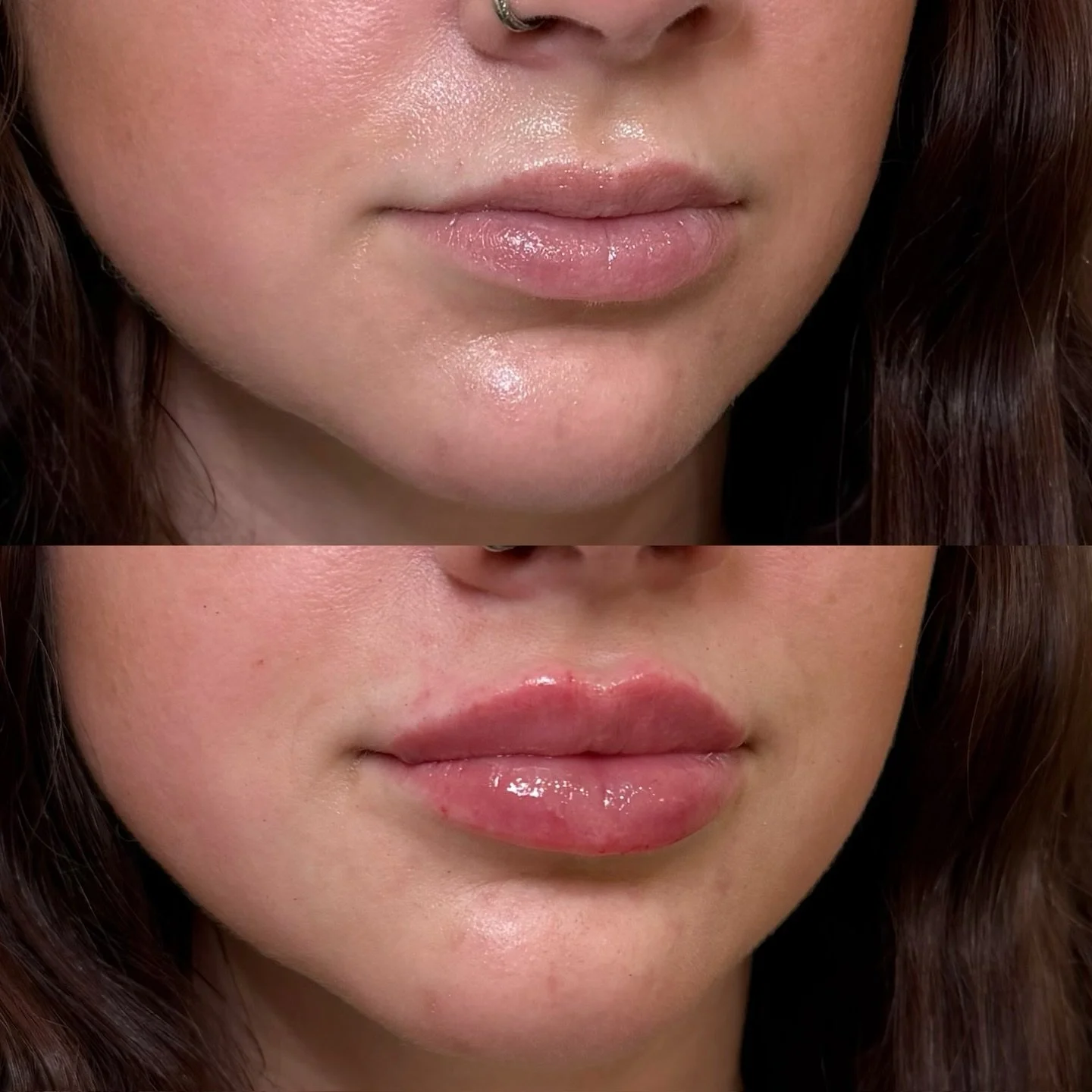 Lip filler for a defined Cupid&rsquo;s bow and central volume

She came in wanting more definition through the Cupid&rsquo;s bow with added fullness focused centrally rather than in the outer corners. The goal was crisp borders, enhanced shape, and a