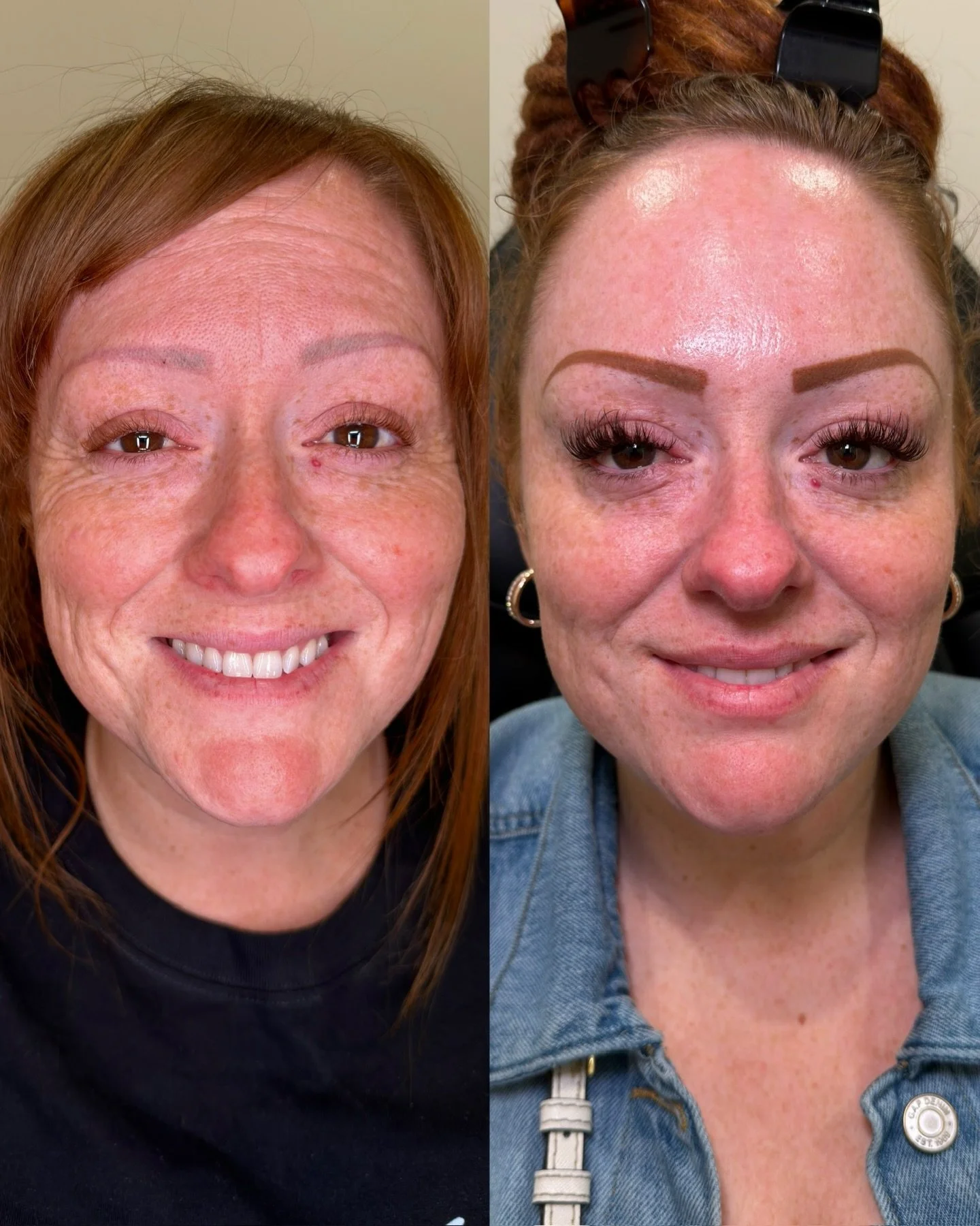 Upper face + DAO tox to refresh and rejuvenate

This was my client&rsquo;s first experience with injectables and she wanted to focus on minimizing the appearance of fine lines/wrinkles in her upper face area.

Using Xeomin, we treated her frontalis, 