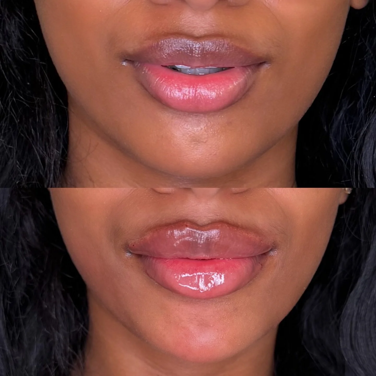 Plump, defined lip filler

This treatment focused on creating fuller, more defined lips while keeping the result true to her natural features. Strategic placement enhanced the Cupid&rsquo;s bow, refined the borders, and added volume through the cente