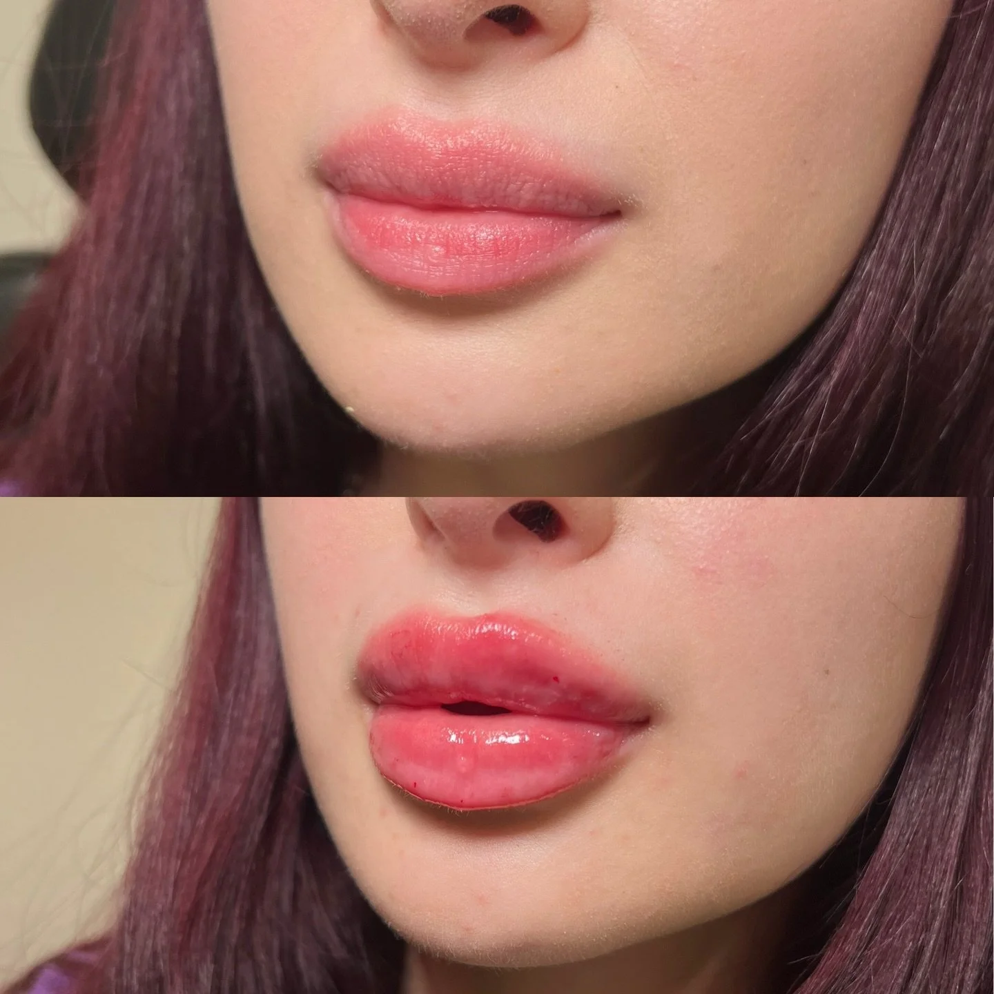 Definition + Hydration to bring out the true shape of her lips using our Russian Lip Technique. 

Location: Plump Medspa 
Service: Lip Filler 

&bull; Immediate swelling ~30%, settles over ~2 weeks
&bull; Photos shared with consent
&bull; Numbing pro