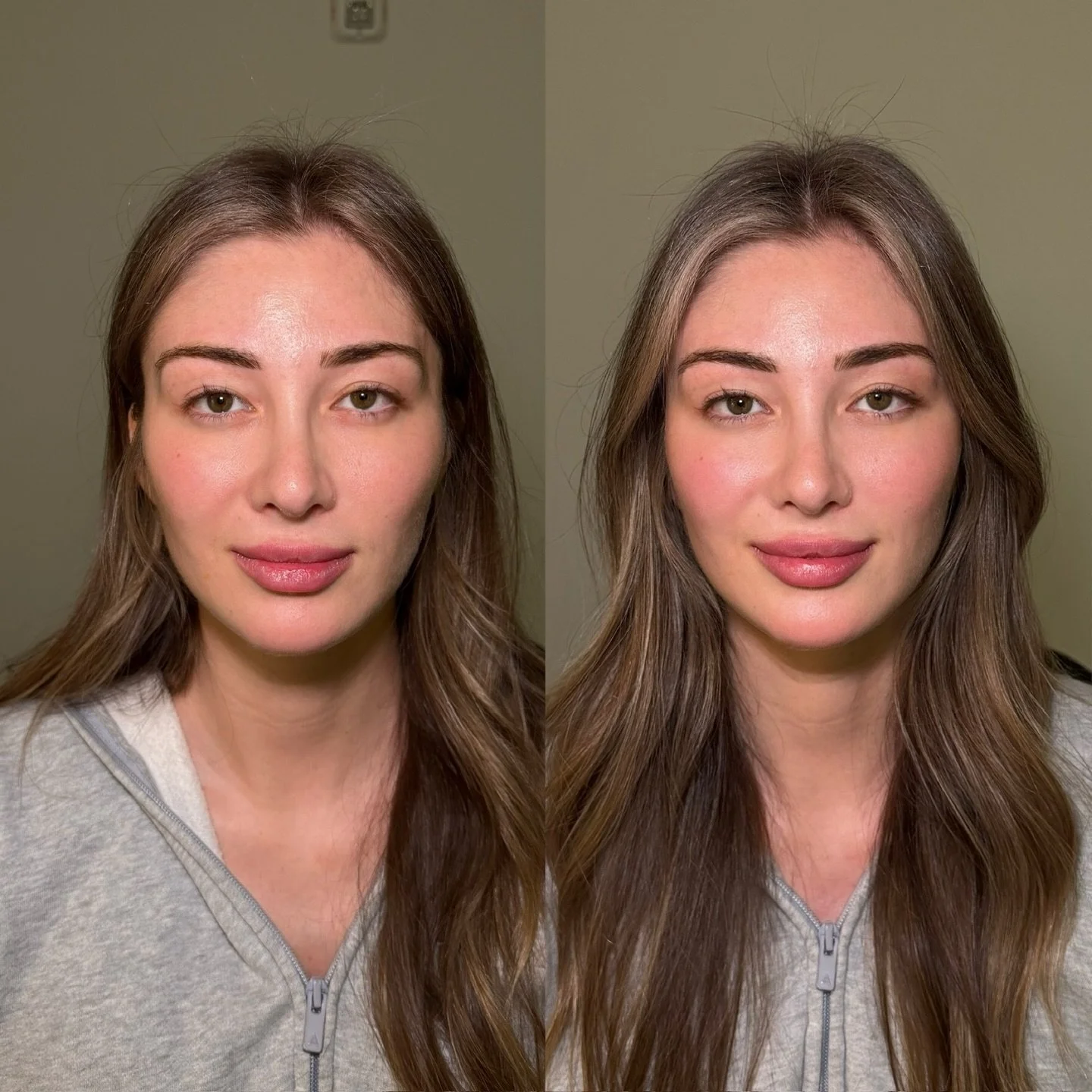 Temple Filler on our gorgeous @ninapherigo 🌸

As we age, we begin to experience bony resorption. Temple hollowing begins to occur as this process continues leading to a &ldquo;sunken&rdquo; or hollowed appearance. 

By adding filler to the temples, 