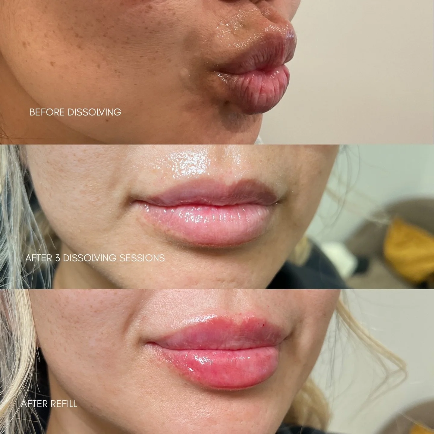 Why results like these couldn&rsquo;t exist without dissolving first ⬇️

This beautiful patient came to me with the intention of receiving Russian Lip Filler. In good conscience, I would not be able to provide the level of results that we are capable