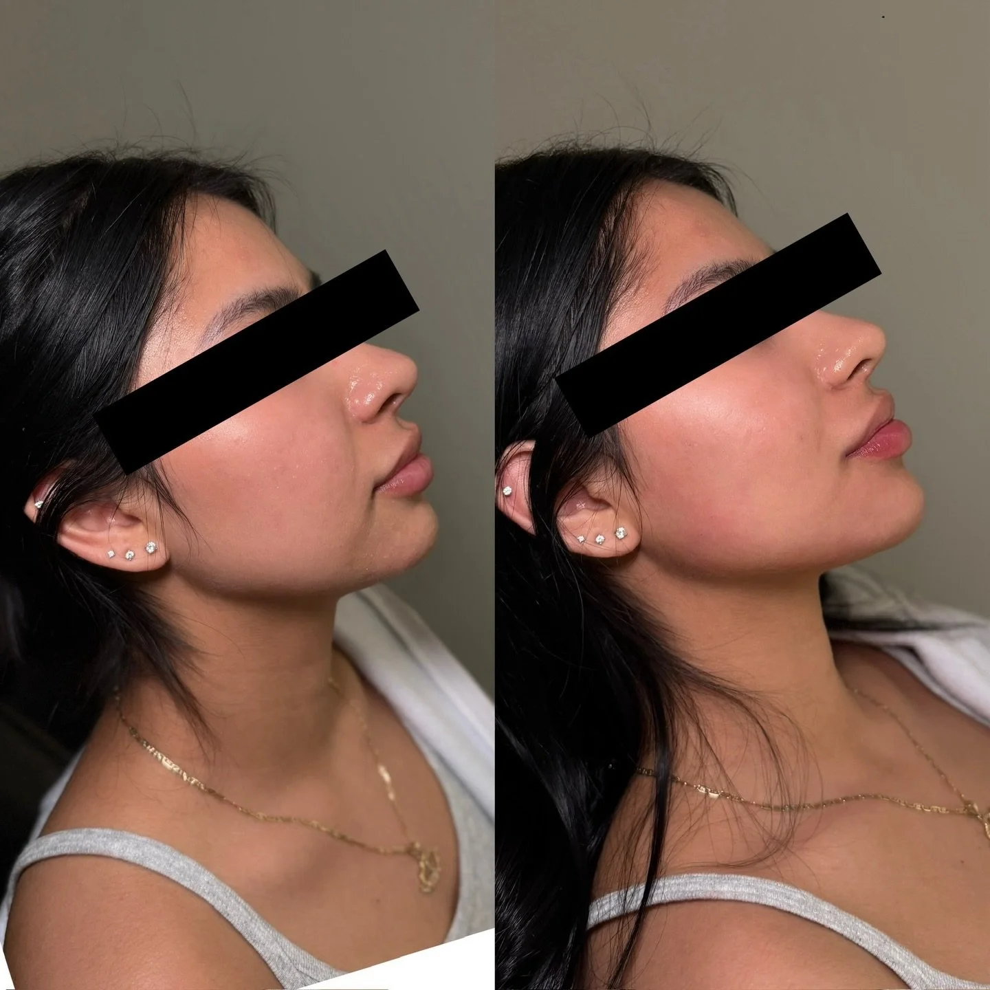 Chin + chin shadow filler for feminine definition

This treatment focused on refining the lower face with chin and chin shadow filler to improve projection, soften transitions, and enhance overall jawline definition. By supporting the chin and addres