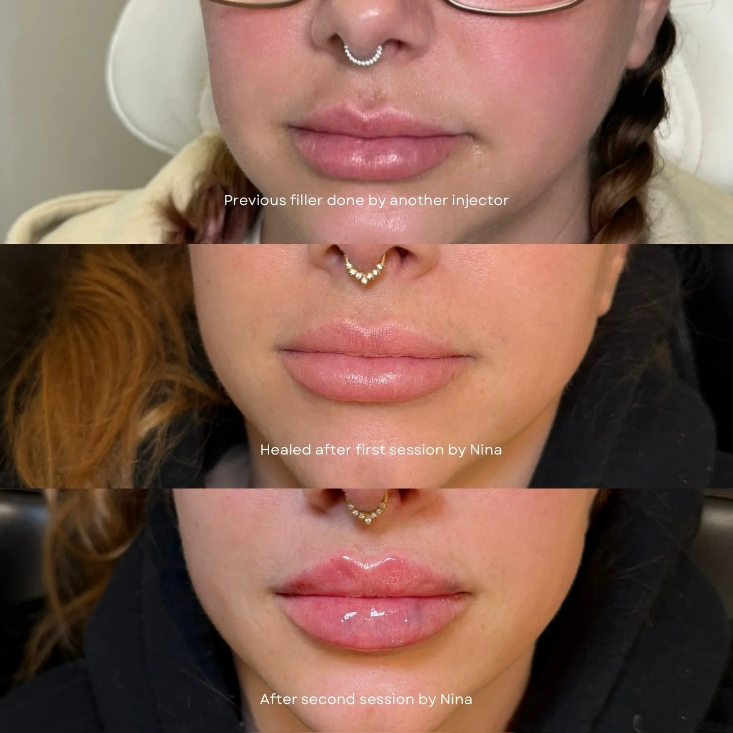 Lip refinement journey

This patient came in with existing lip filler and a clear vision for her ideal shape. Over the course of two sessions, we focused on refining structure, improving balance, and enhancing definition to help her reach her lip goa