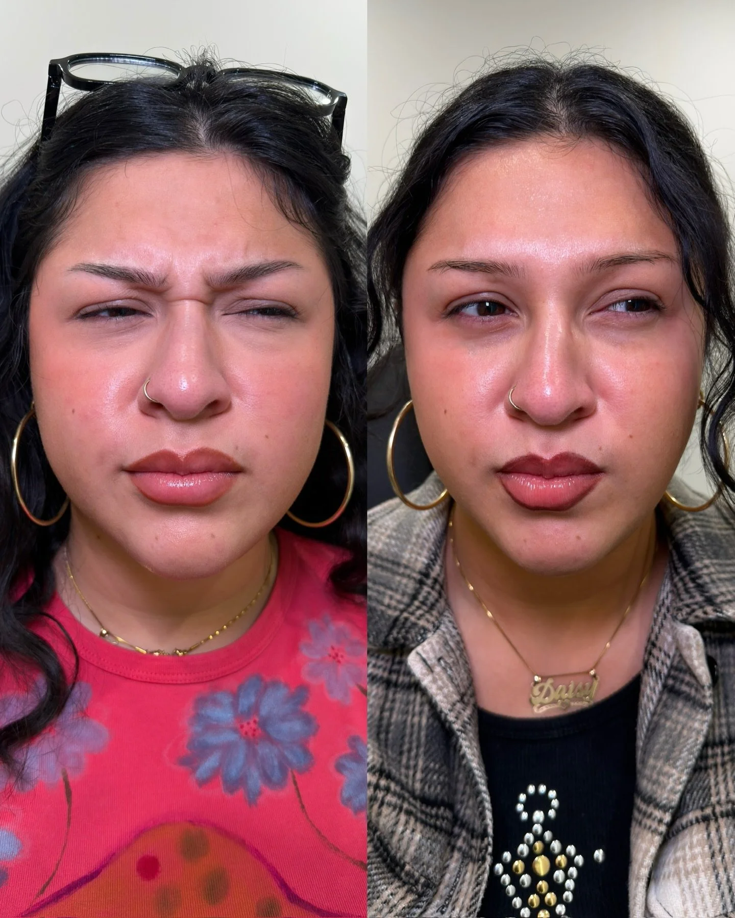 Upper face + nose bridge + masseter tox

Using Xeomin, we treated these areas to provided a lifted, rejuvenated appearance as well as relief of jaw clenching pain/slimming the lower face.

Service: Botulinum toxin (Tox)
Injector: Rachael
Location: Pl