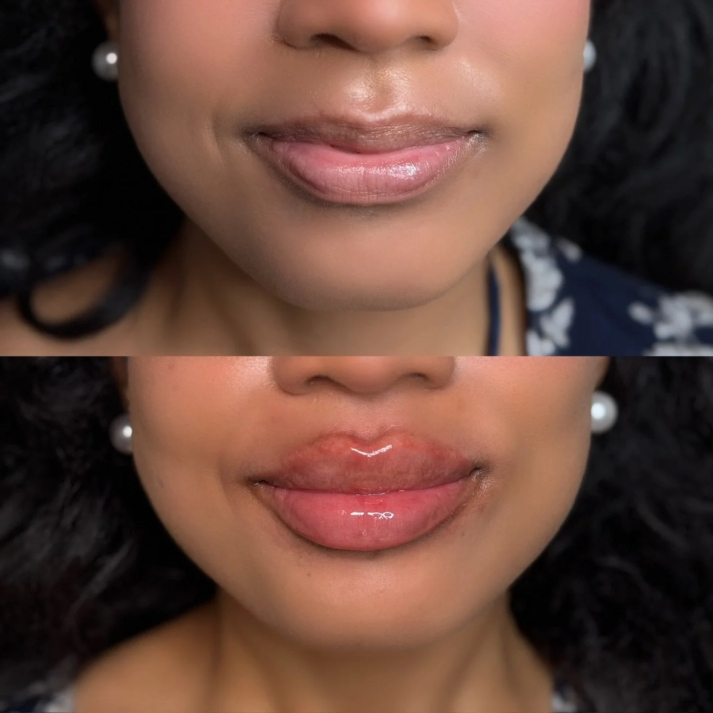 Patient&rsquo;s lips, but better

This treatment focused on enhancing her natural lip shape while keeping the result true to her features. Strategic placement refined the borders, improved symmetry, and added soft volume to create a more balanced, po